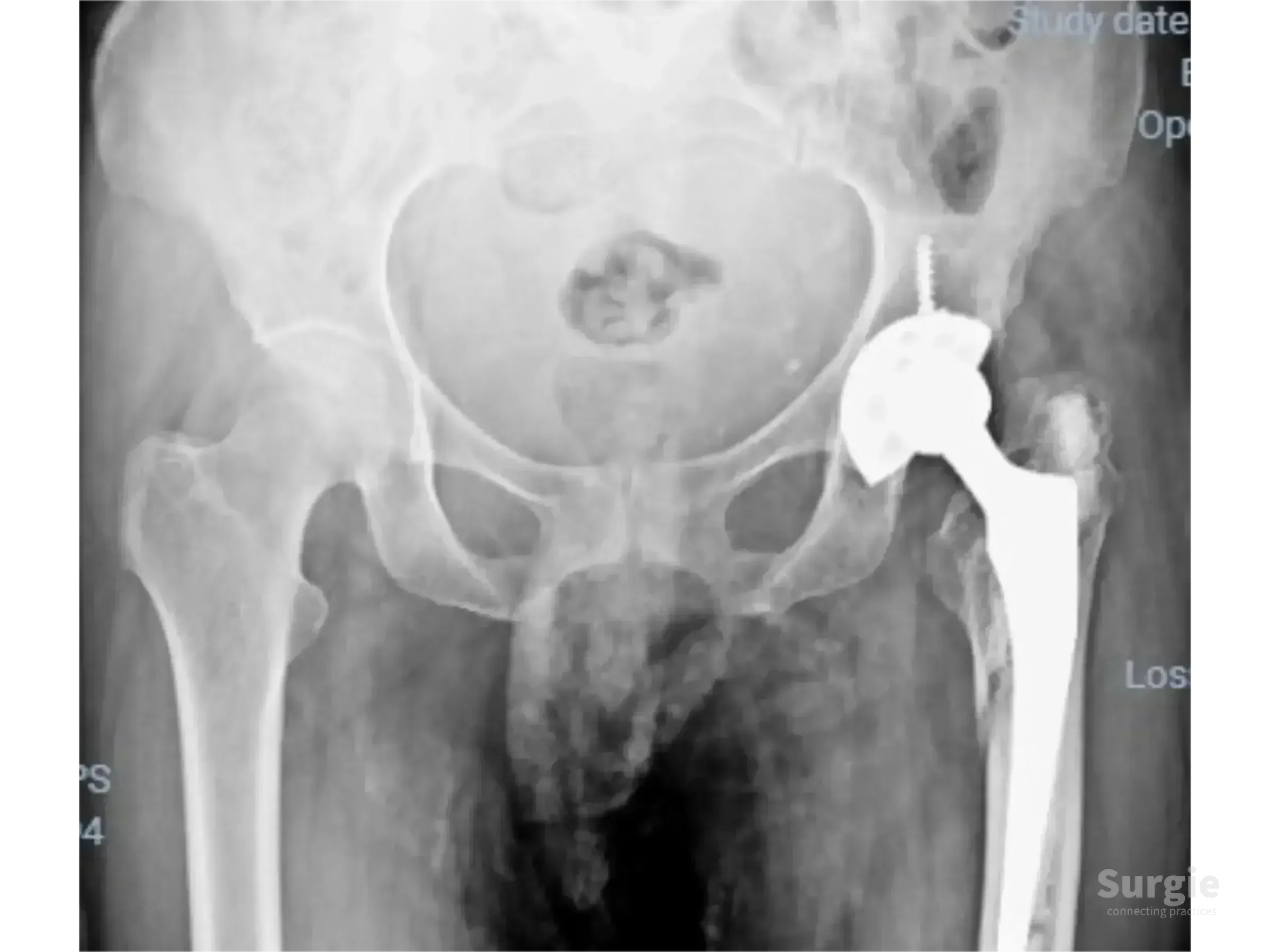 Pelvic X-ray showing a periprosthetic hip fracture treated with a trochanteric plate and cerclage cables.