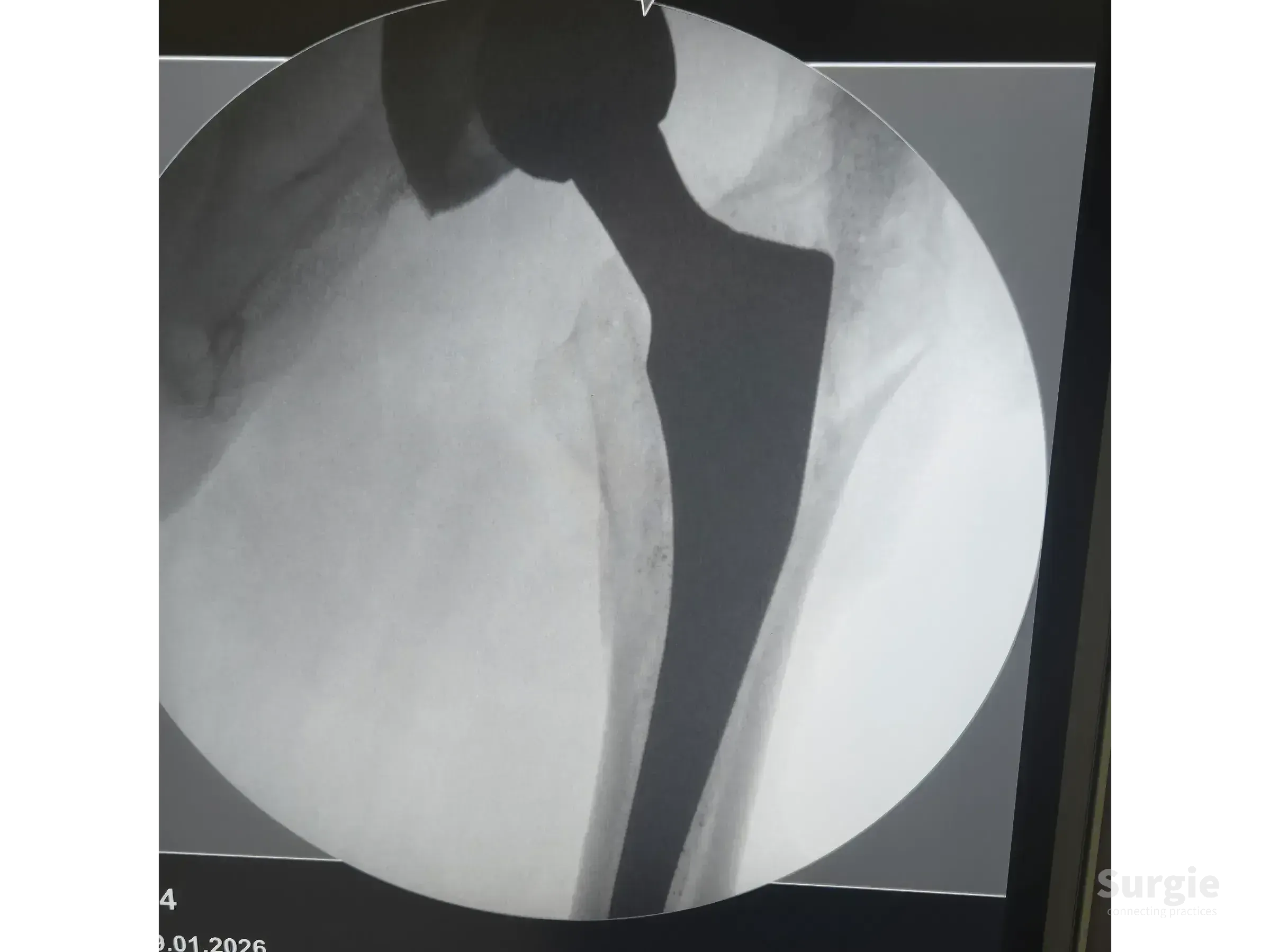 X-ray showing a metal hip prosthesis stem implanted in the femur, highlighting the periprosthetic fracture site.