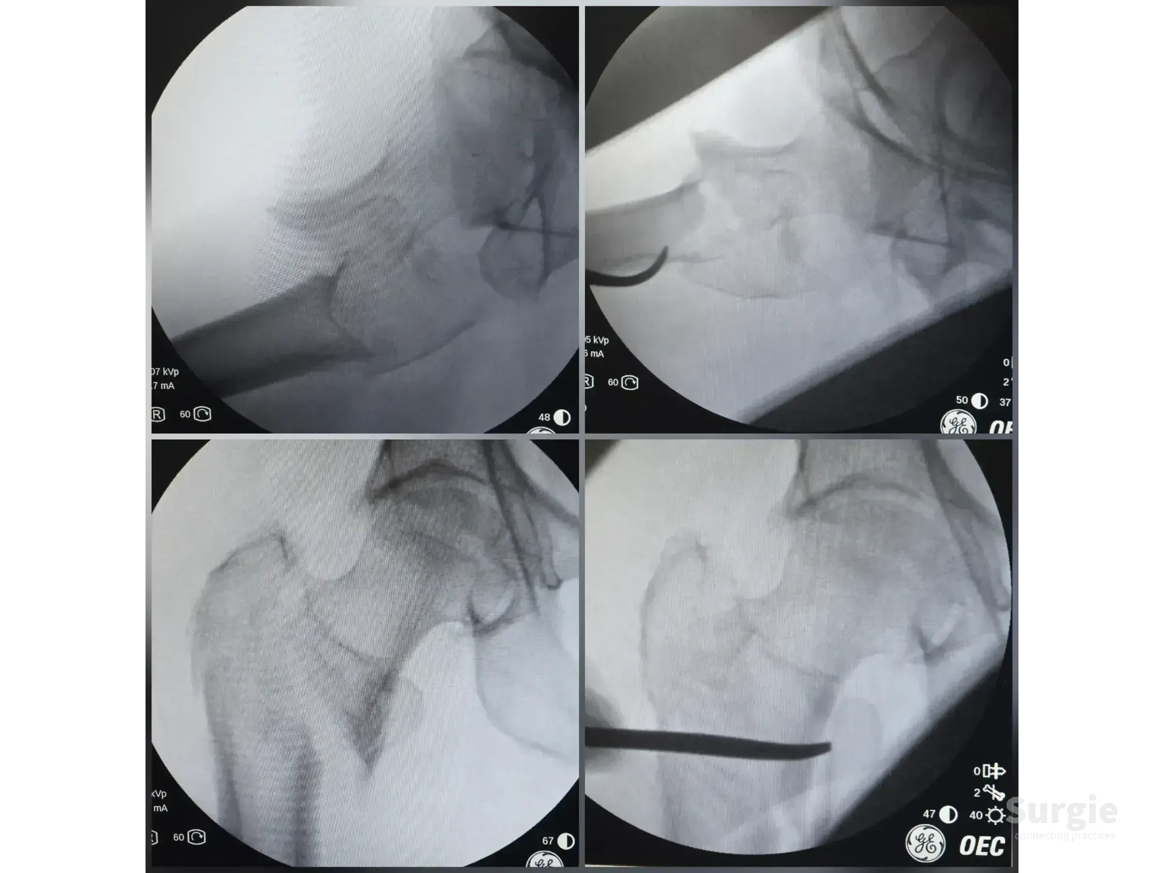 Fluoroscopic X-ray images showing percutaneous reduction of an unstable proximal femur fracture using the double seesaw technique.