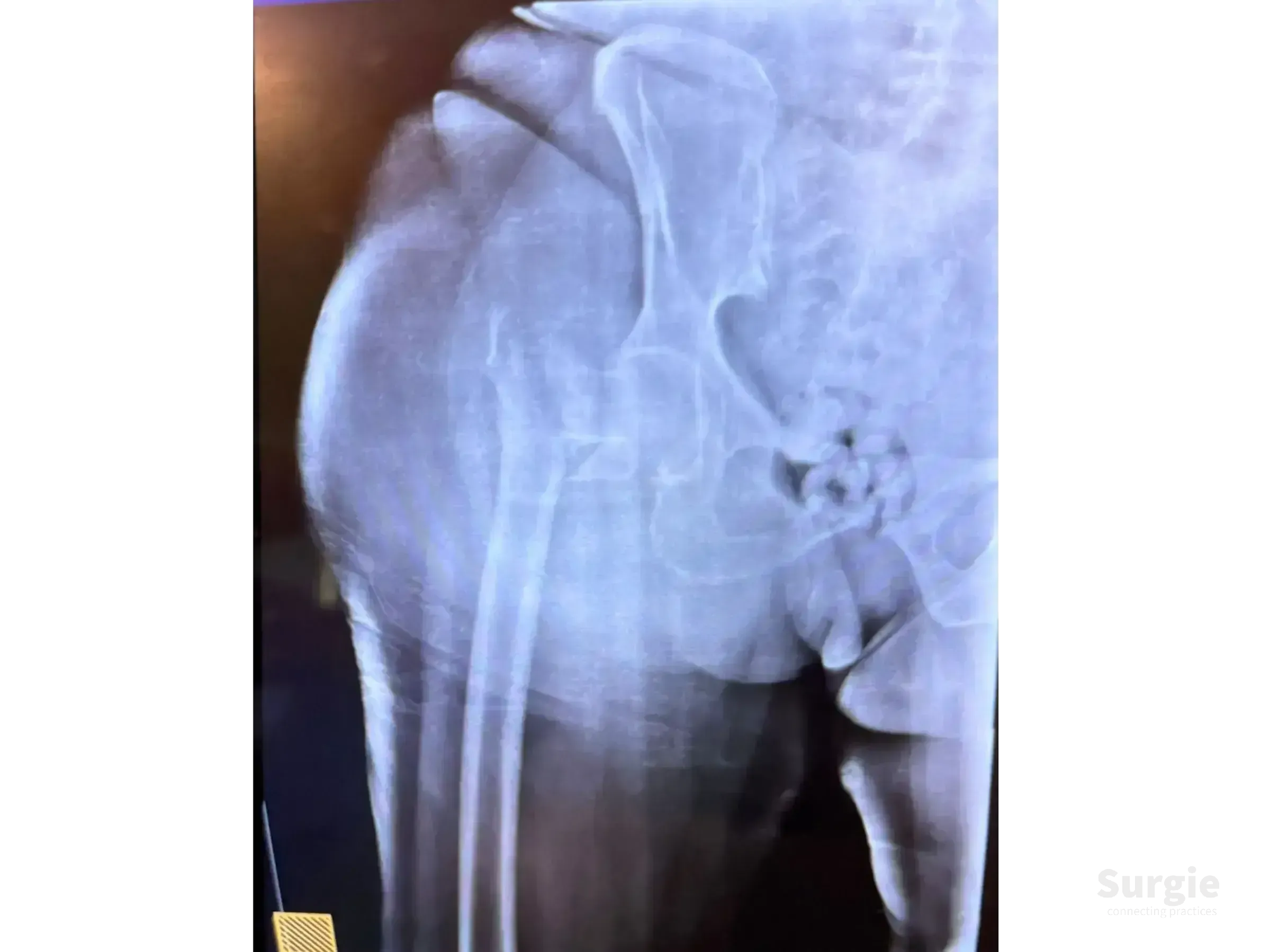 X-ray showing an unstable, multifragmentary transtrochanteric hip fracture requiring percutaneous reduction.