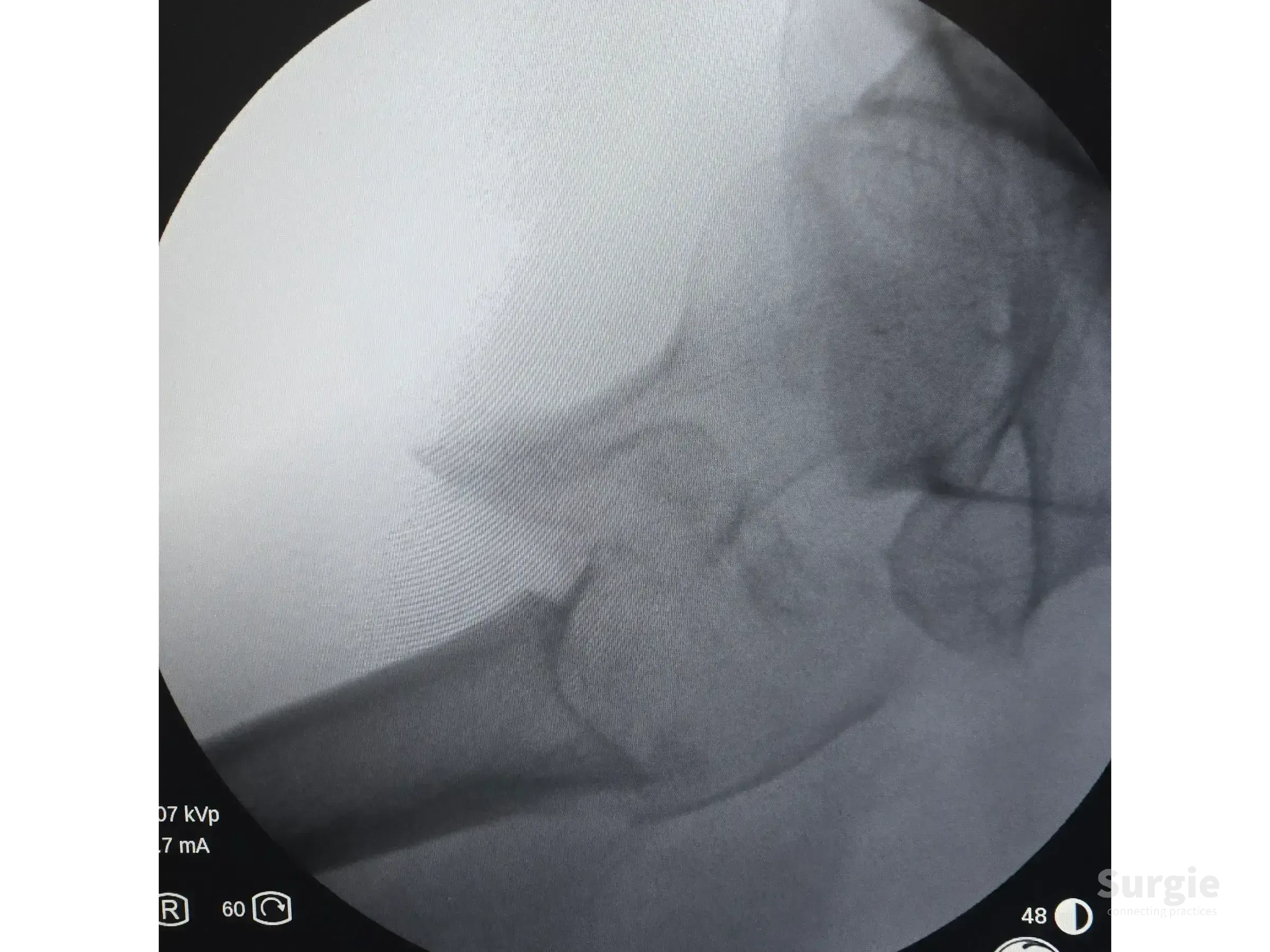 Fluoroscopic X-ray showing an unstable, multifragmentary transtrochanteric hip fracture before reduction.