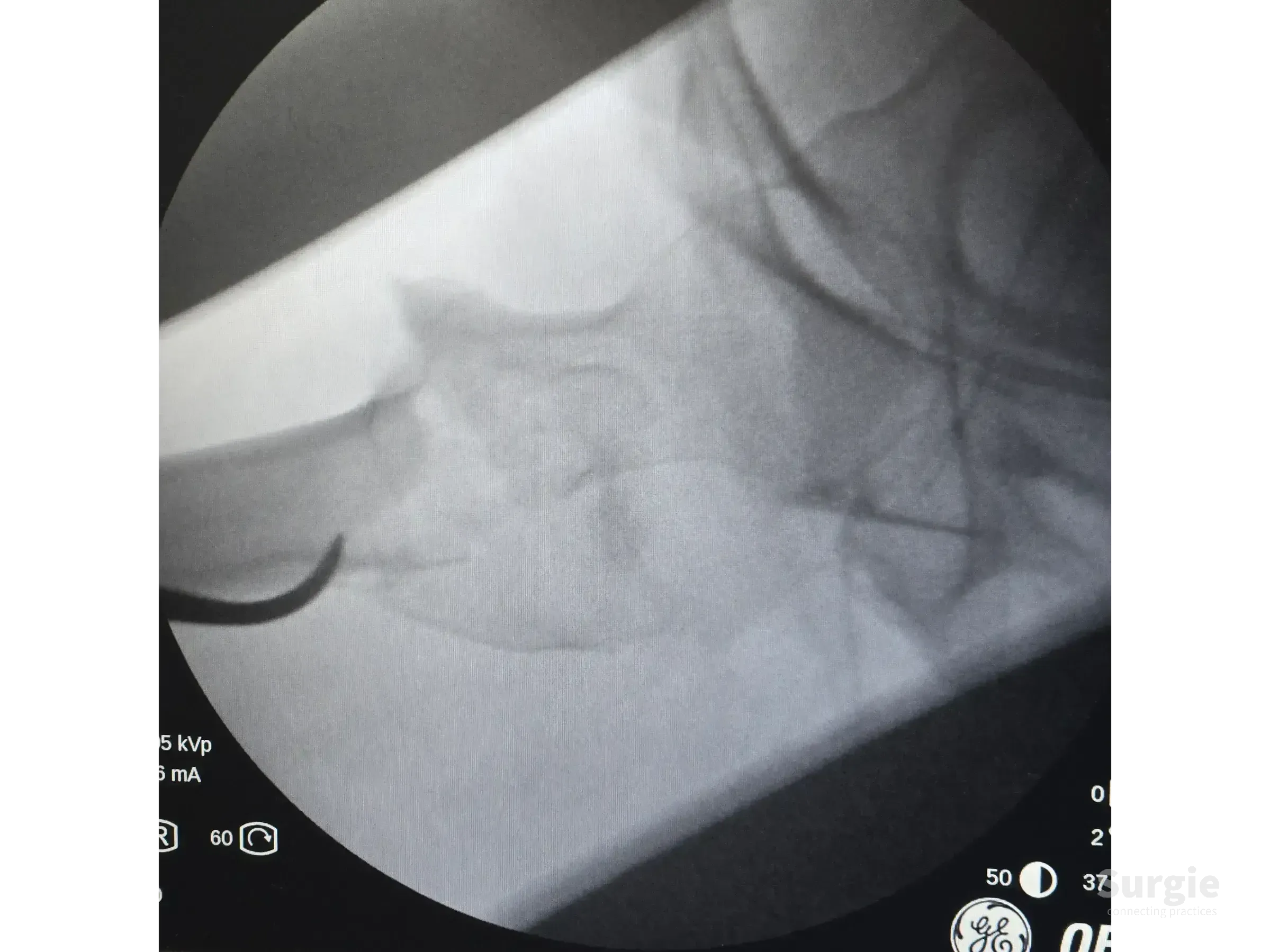 Fluoroscopic X-ray showing percutaneous reduction of an unstable proximal femur fracture using the double seesaw technique.
