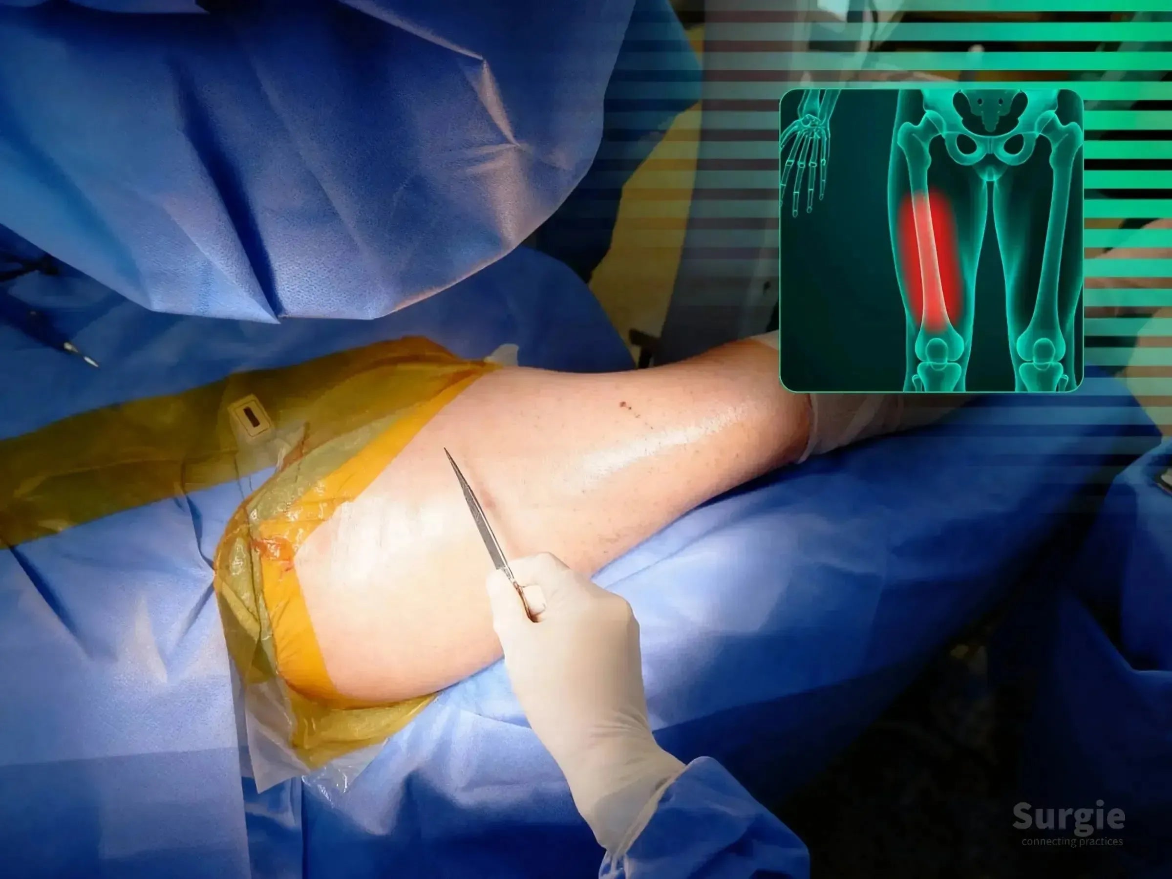 Surgeon performing percutaneous reduction on a patient's thigh with a digital femoral fracture overlay.