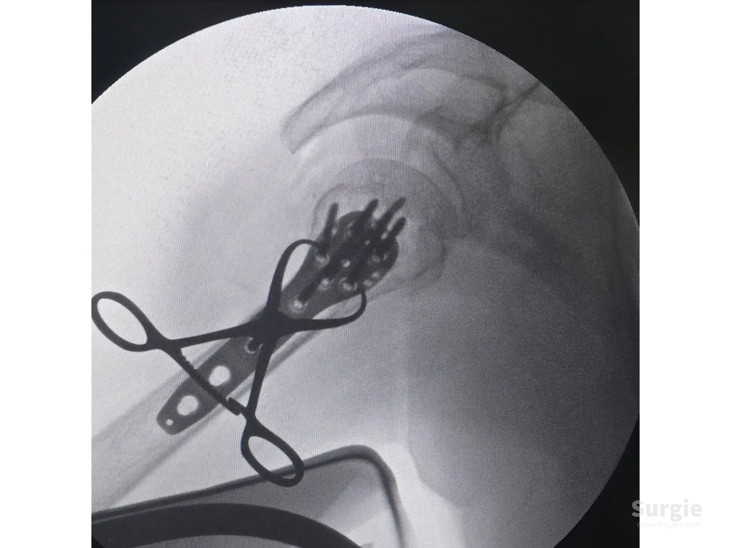 Fluoroscopic view of a proximal humerus fracture fixed with a locking plate and reduction forceps.