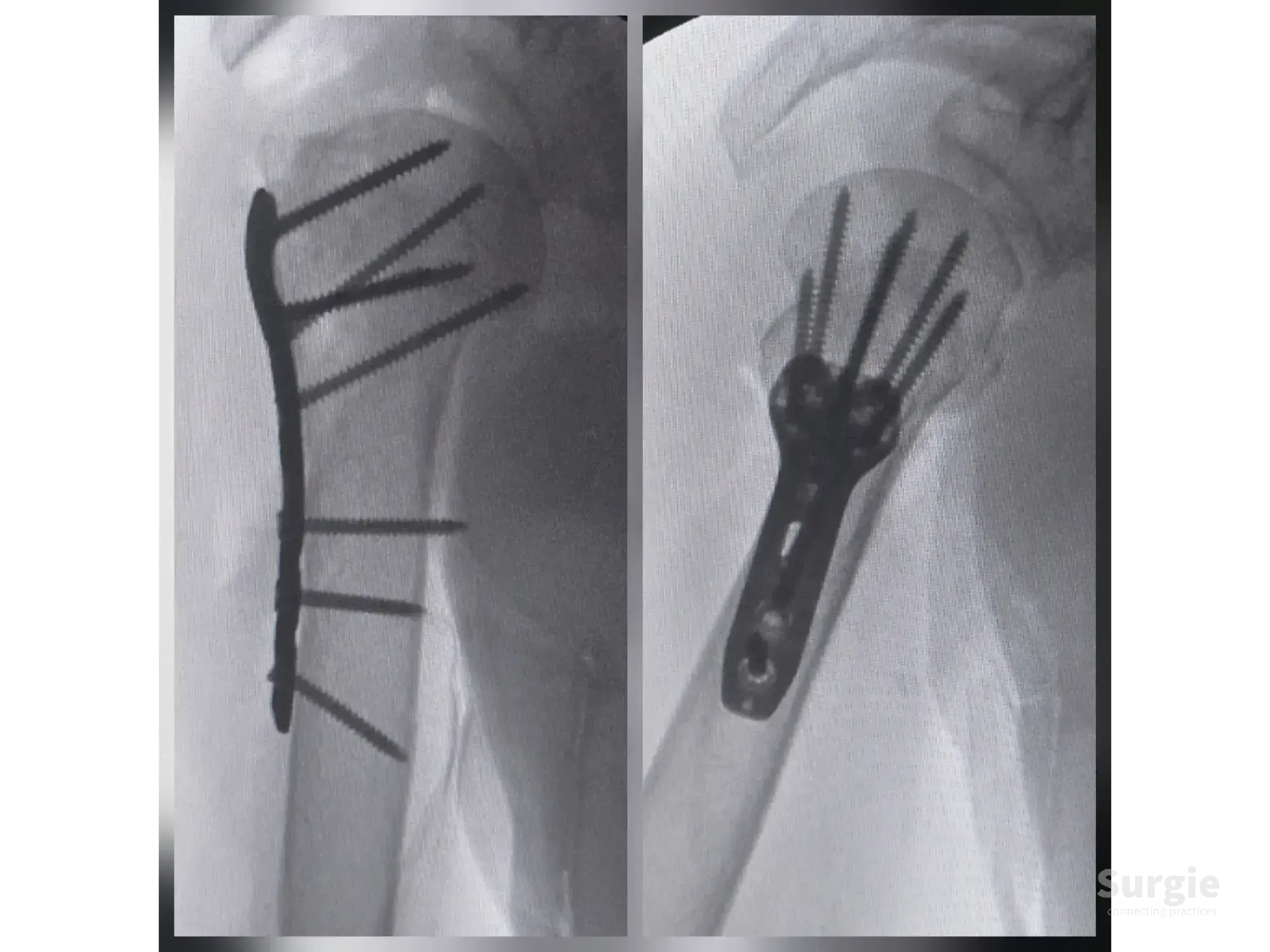 X-ray showing a proximal humerus fracture fixed with a metallic locking plate and multiple screws in two views.
