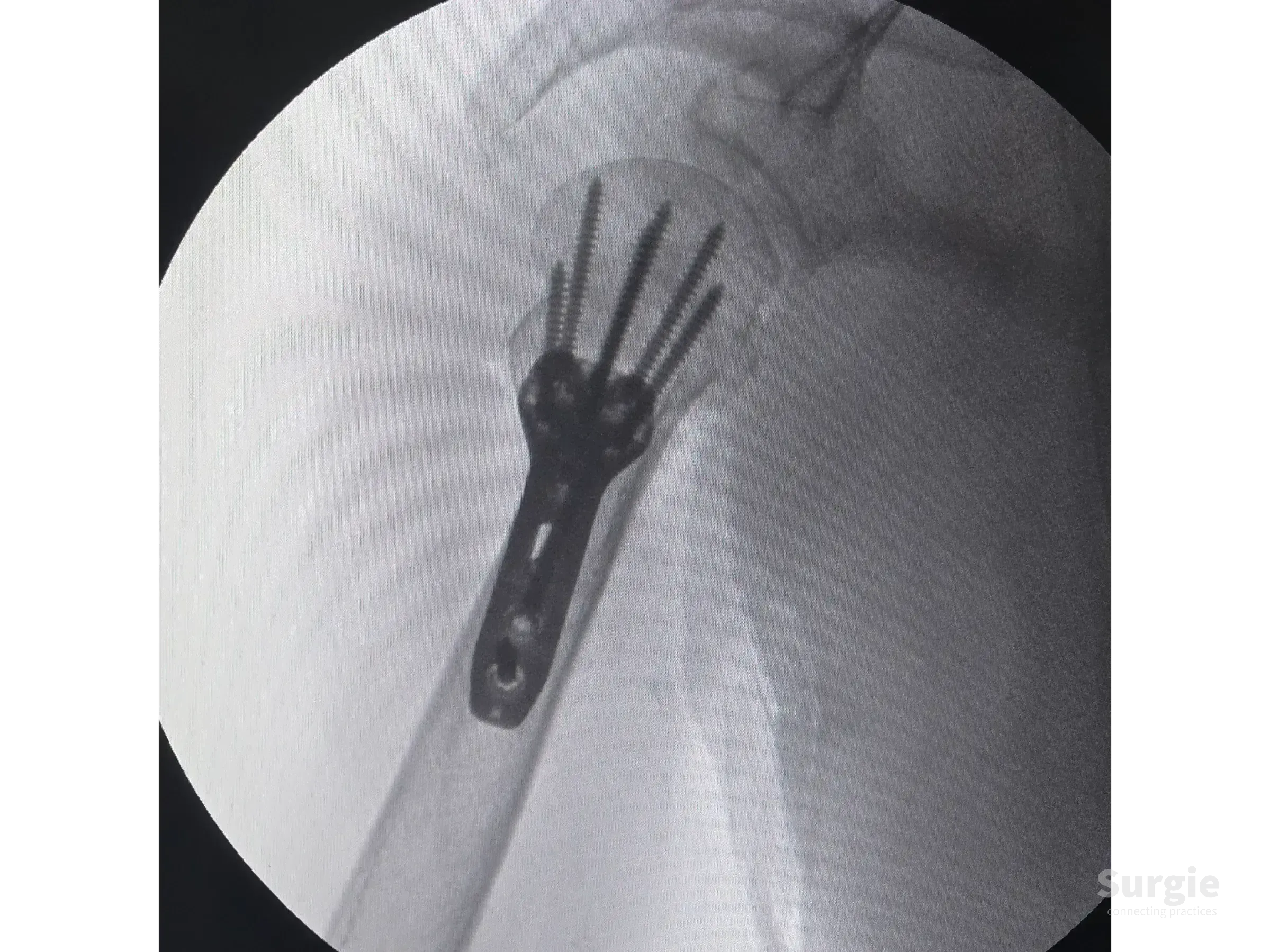 X-ray showing a proximal humerus locking plate and screws fixating a two-part fracture with varus correction.