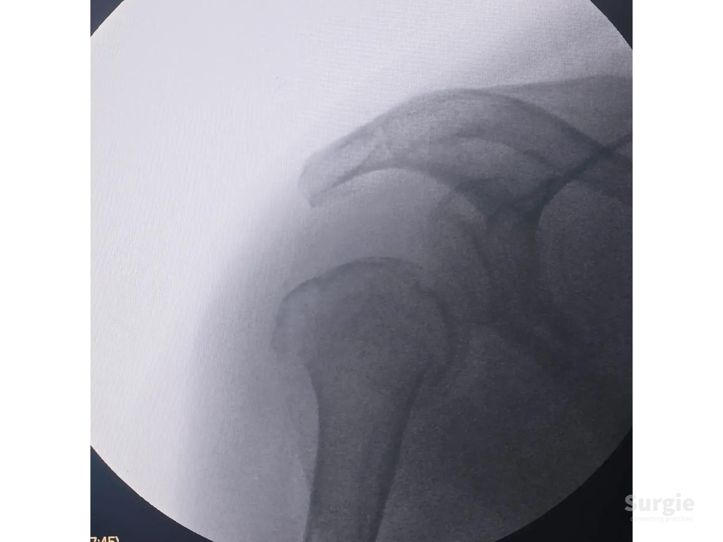 X-ray showing a two-part proximal humerus fracture with varus displacement in a grayscale clinical view.