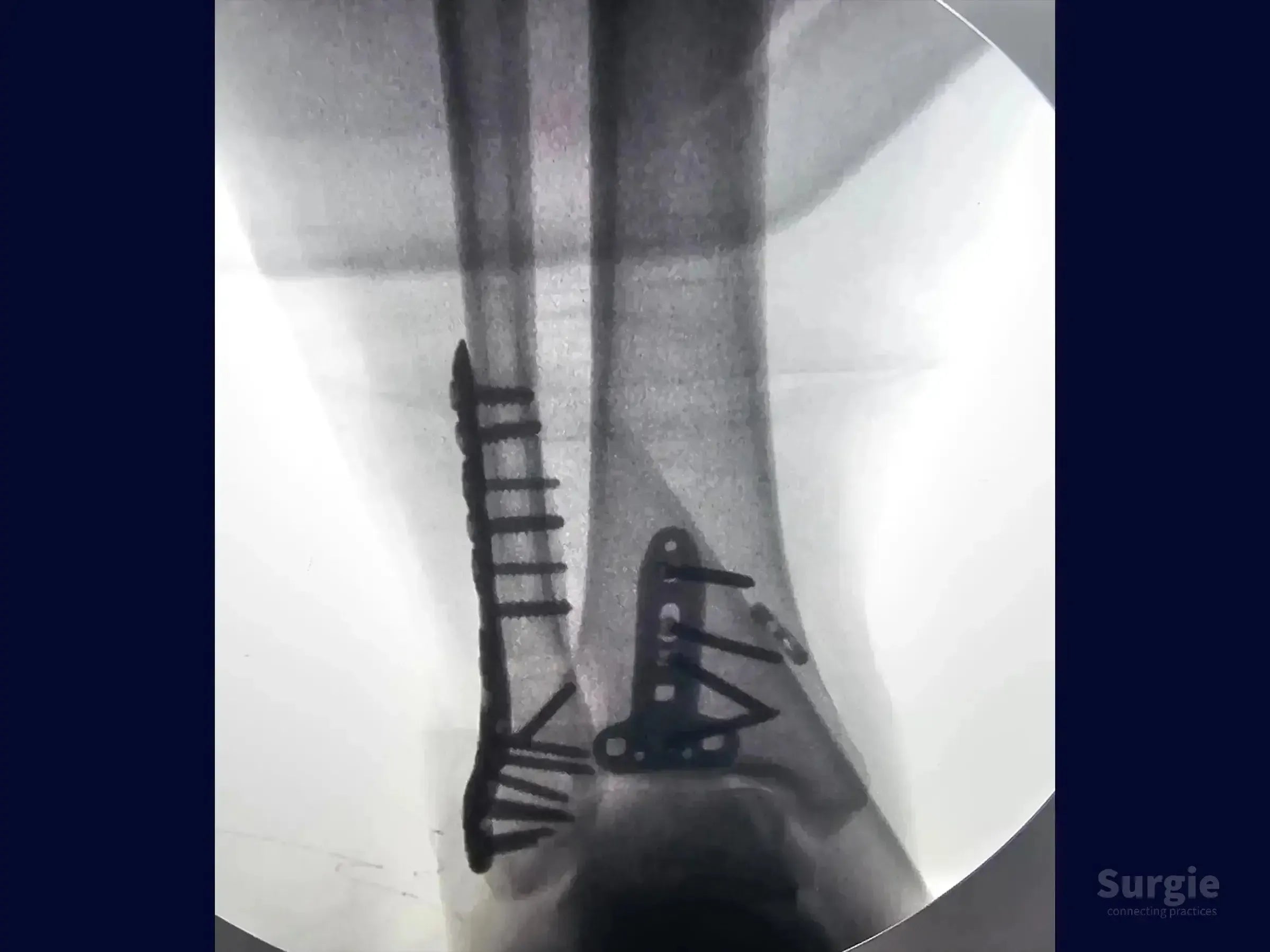 X-ray showing internal fixation of a posterior and lateral malleolus fracture with metal locking plates and screws.