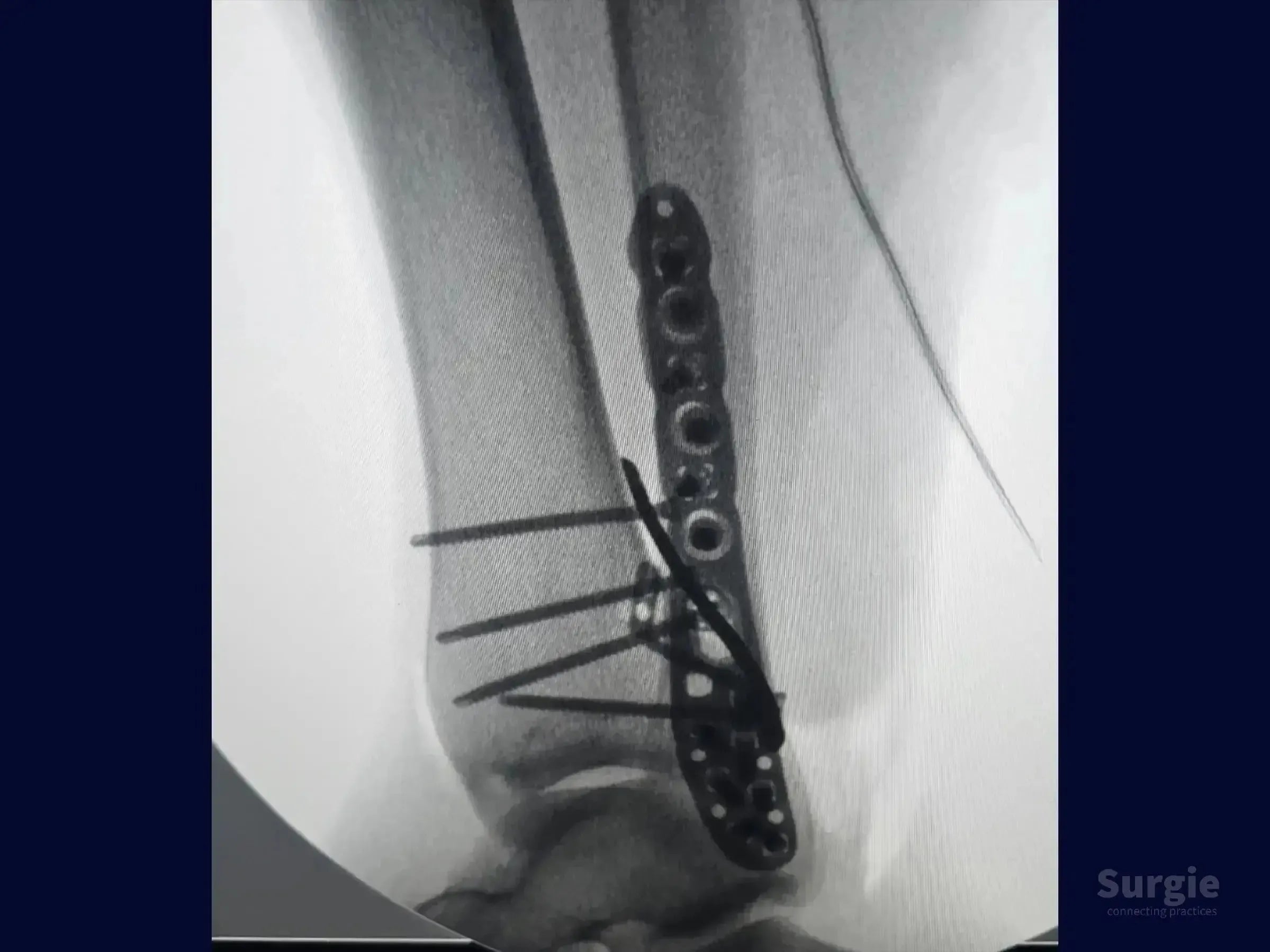 X-ray showing a metal locking plate and interfragmentary screws fixing a posterior and lateral malleolus ankle fracture.