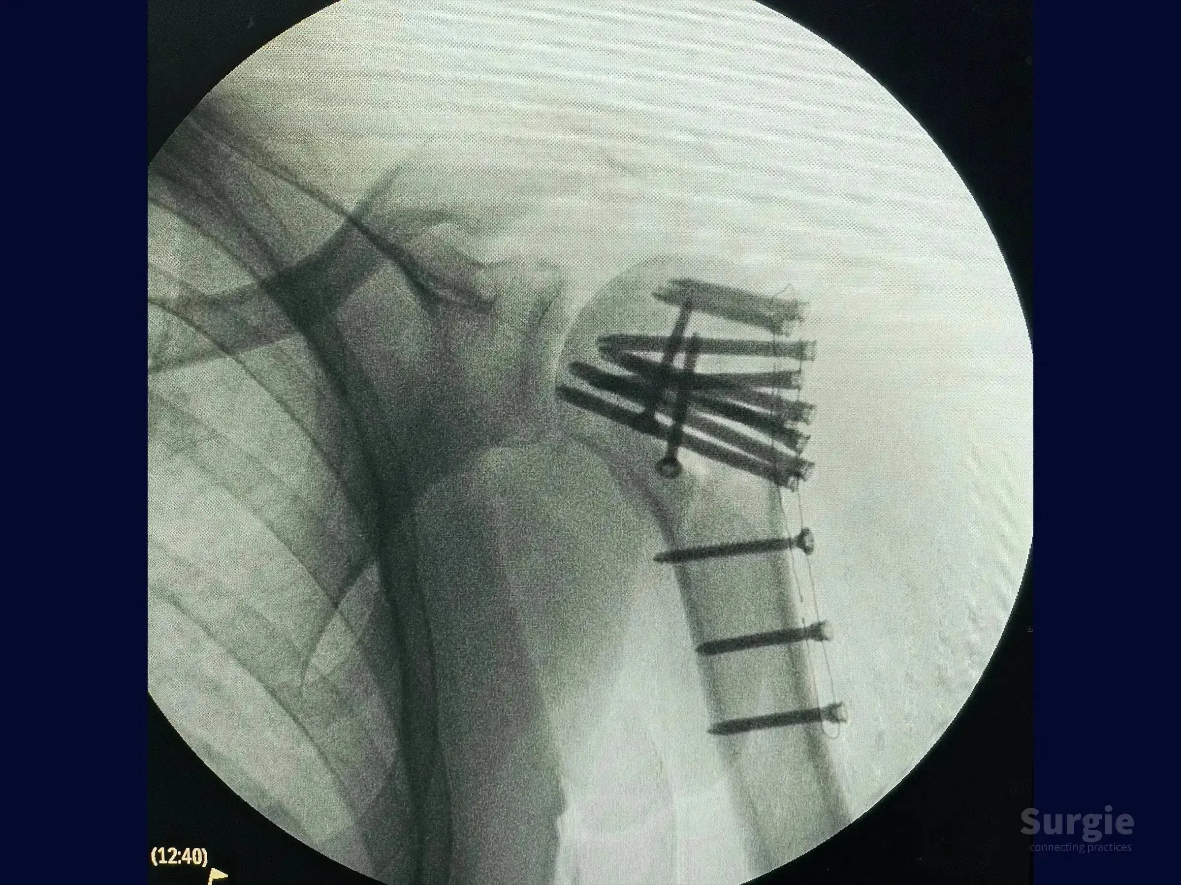 X-ray showing a humeral head fracture fixed with a carbon fiber plate and multiple surgical screws.