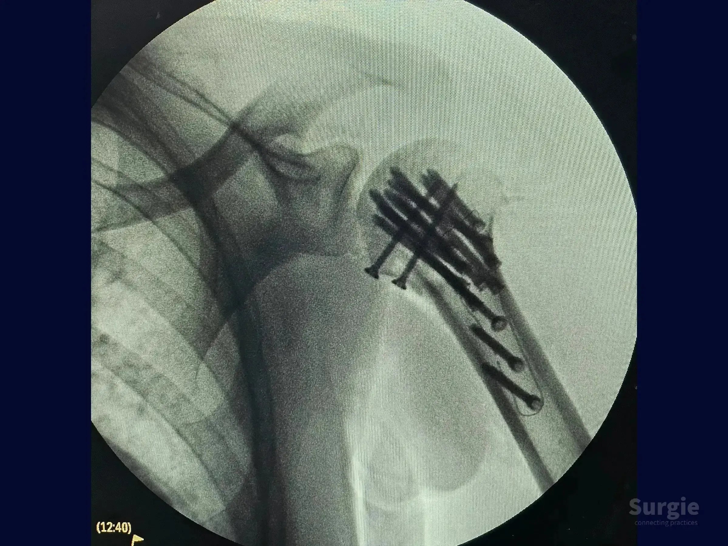 X-ray showing a humeral head fracture fixed with a carbon fiber plate and multiple screws for stabilization.