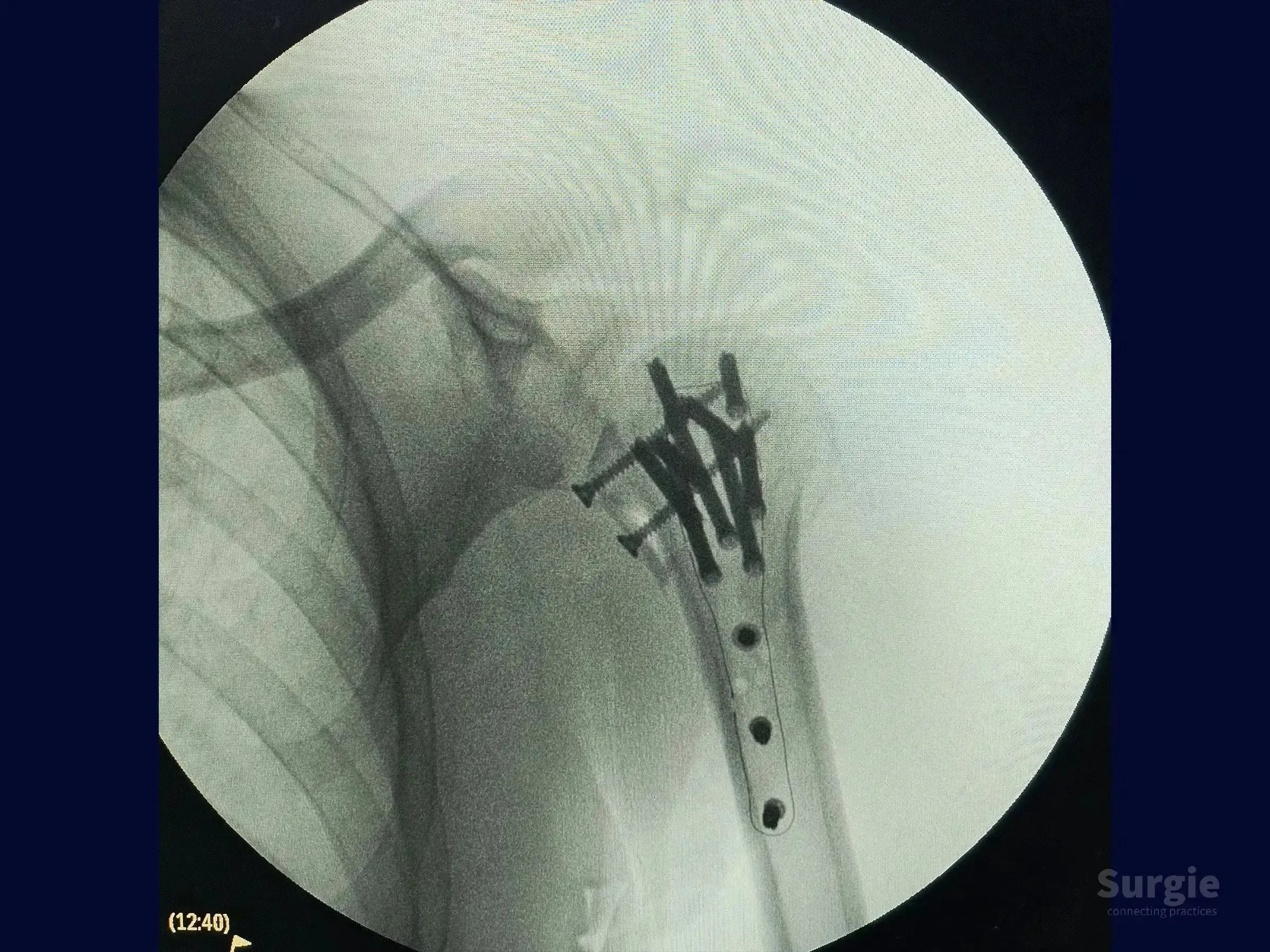 X-ray showing a carbon fiber plate and screws stabilizing a posterior shoulder dislocation with humeral head impaction.