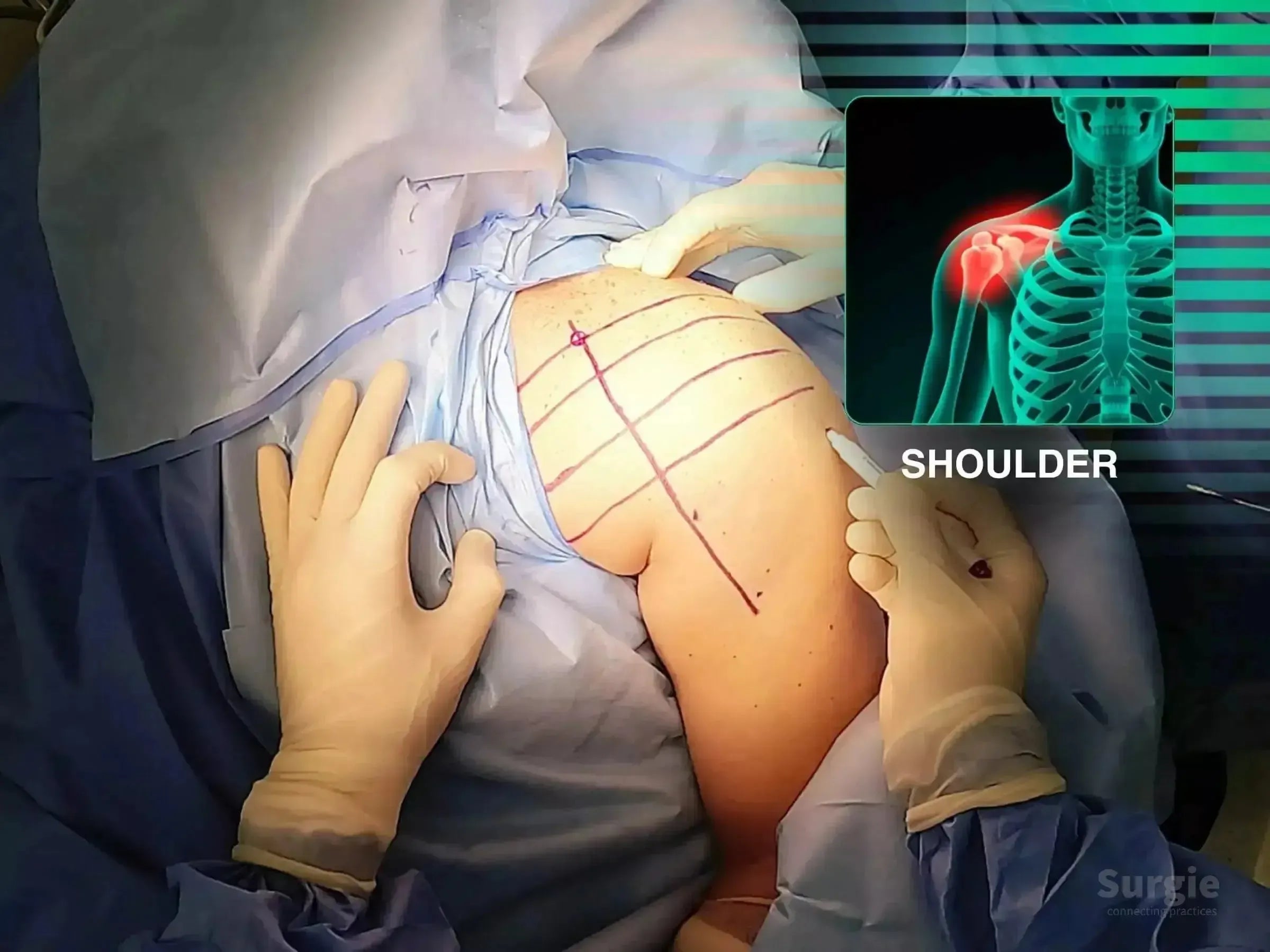 Surgeon marking a patient's shoulder for a deltopectoral approach with an anatomical diagram overlay.