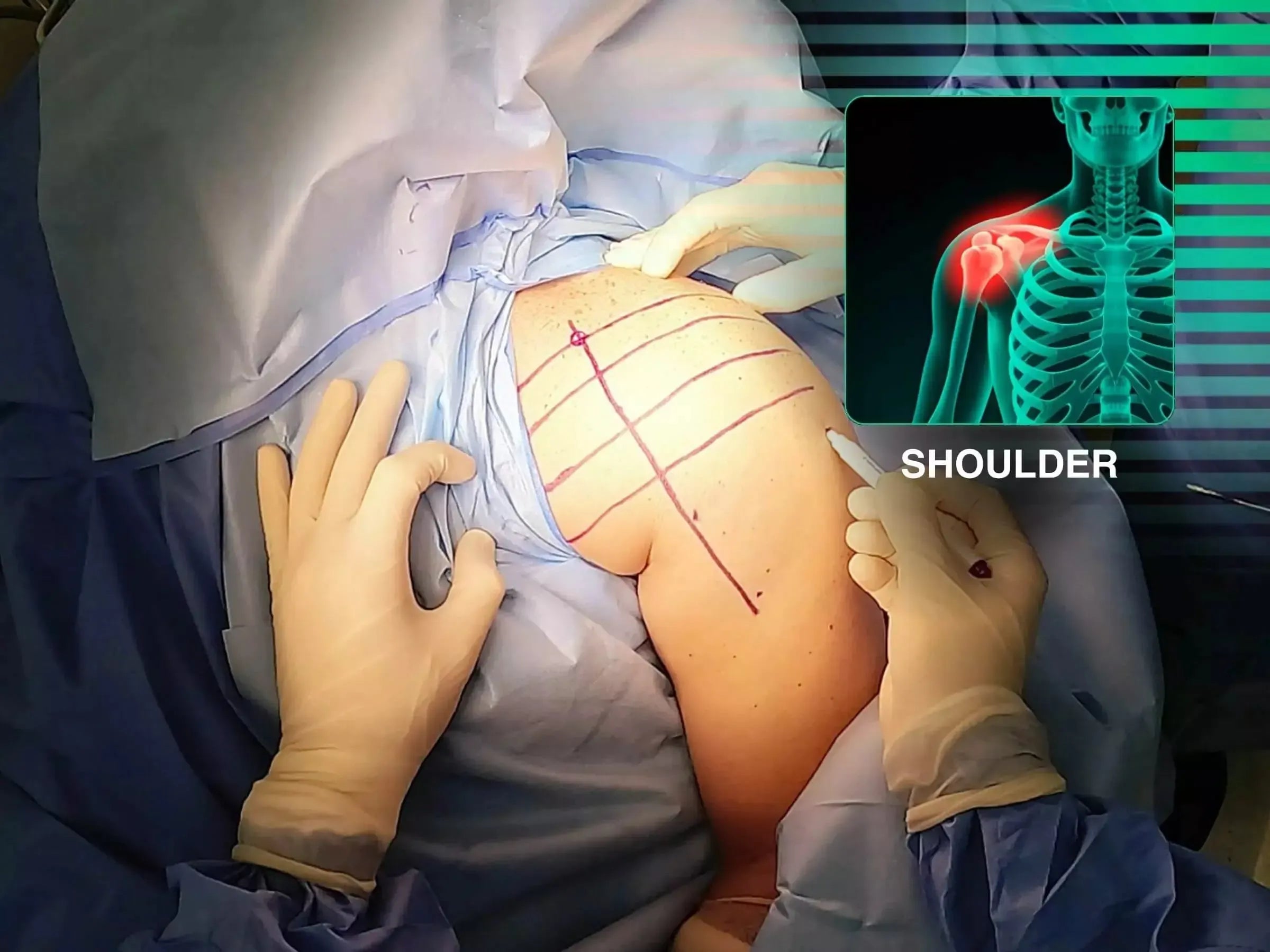 Posterior Shoulder Dislocation with Humeral Head Impaction