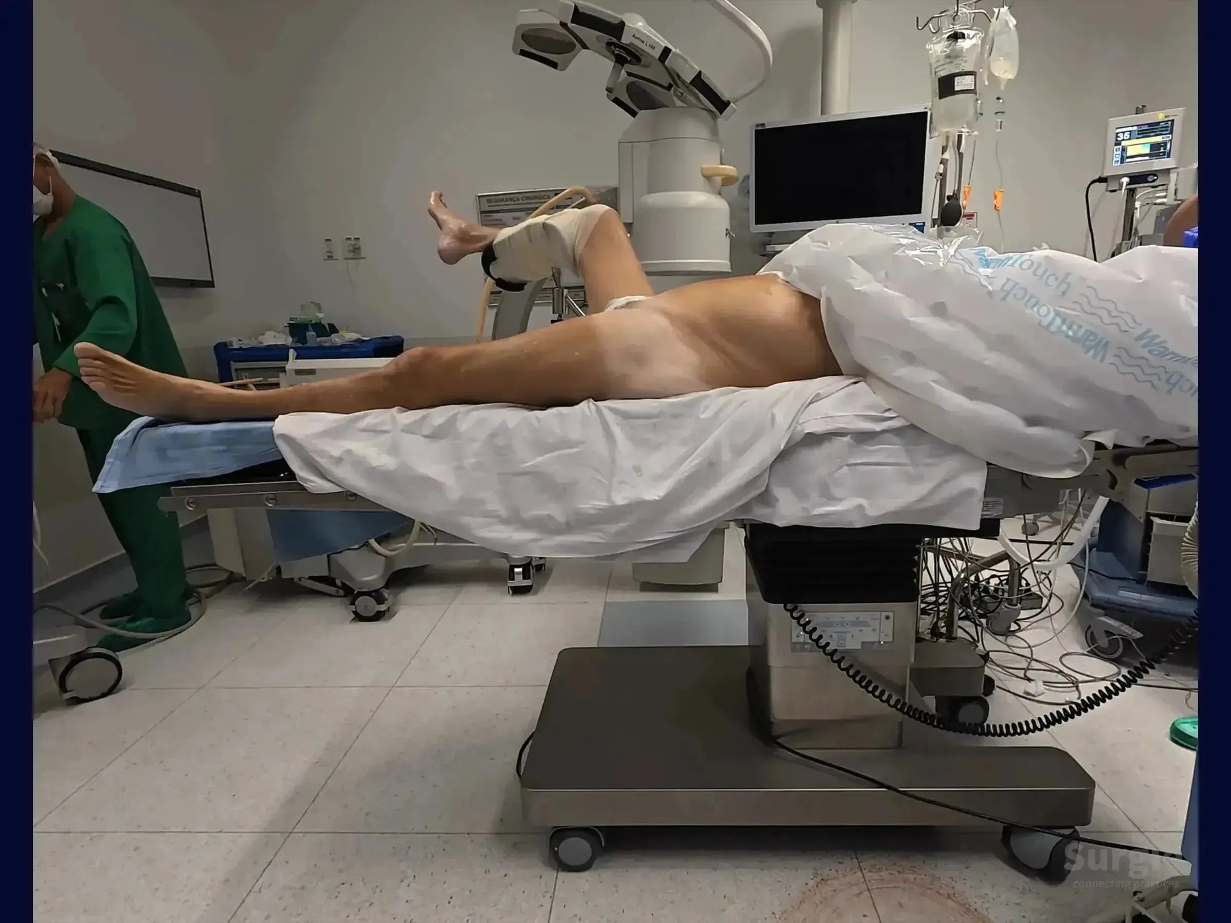 Patient positioned on a conventional surgical table for femur fracture surgery with a C-arm and medical staff present.