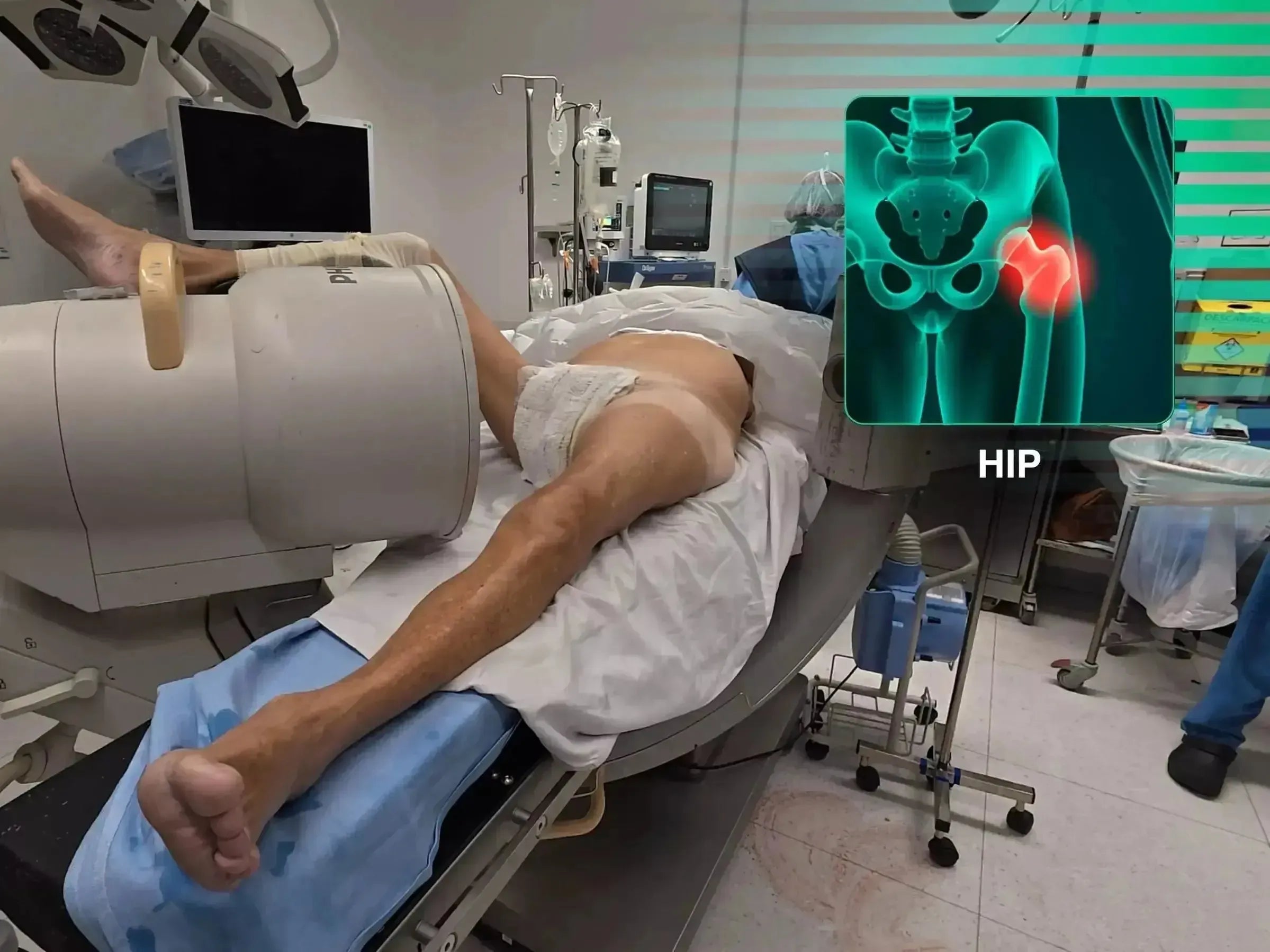 Patient positioned on a conventional surgical table for proximal femur fracture surgery with C-arm and hip anatomy overlay.