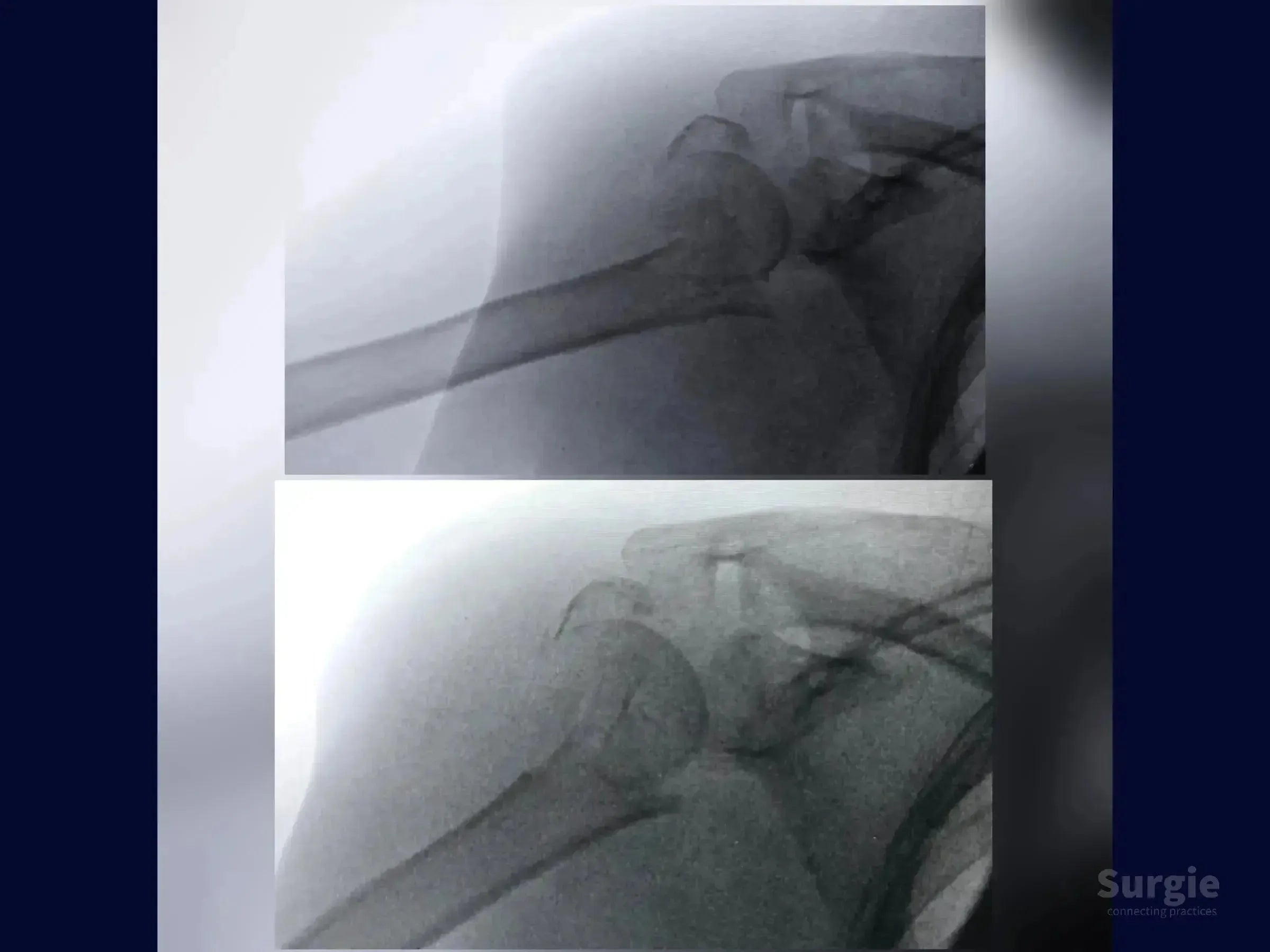 X-ray showing a complex four-part proximal humerus fracture with valgus impaction before and after surgical reduction.