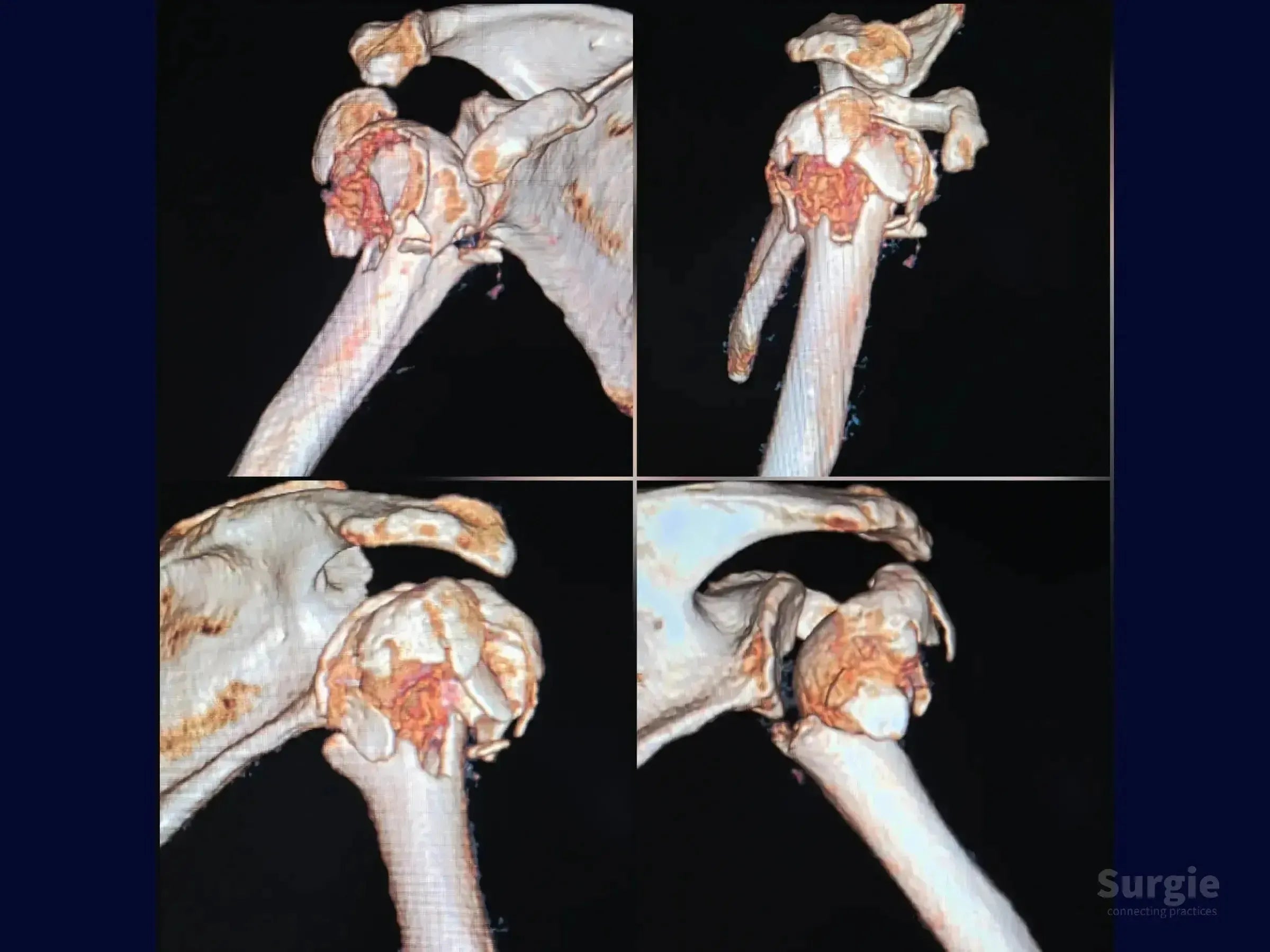 3D CT scan showing a complex four-part proximal humerus fracture with valgus impaction from multiple angles.