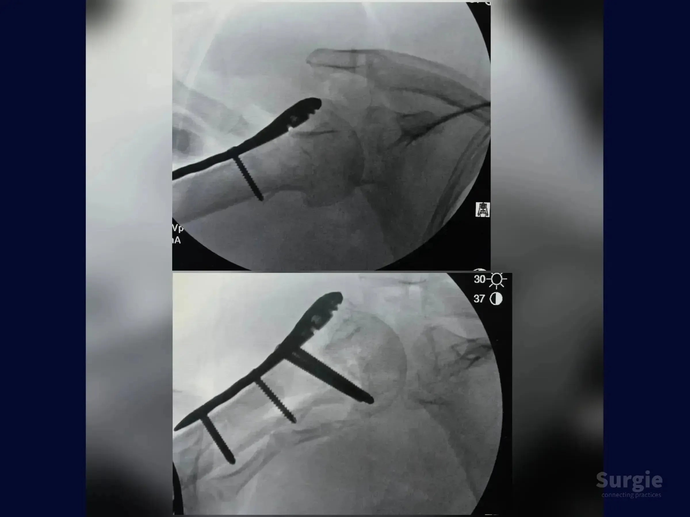 X-ray showing proximal humerus four-part fracture fixation with a locking plate and calcar screws for anatomical reduction.