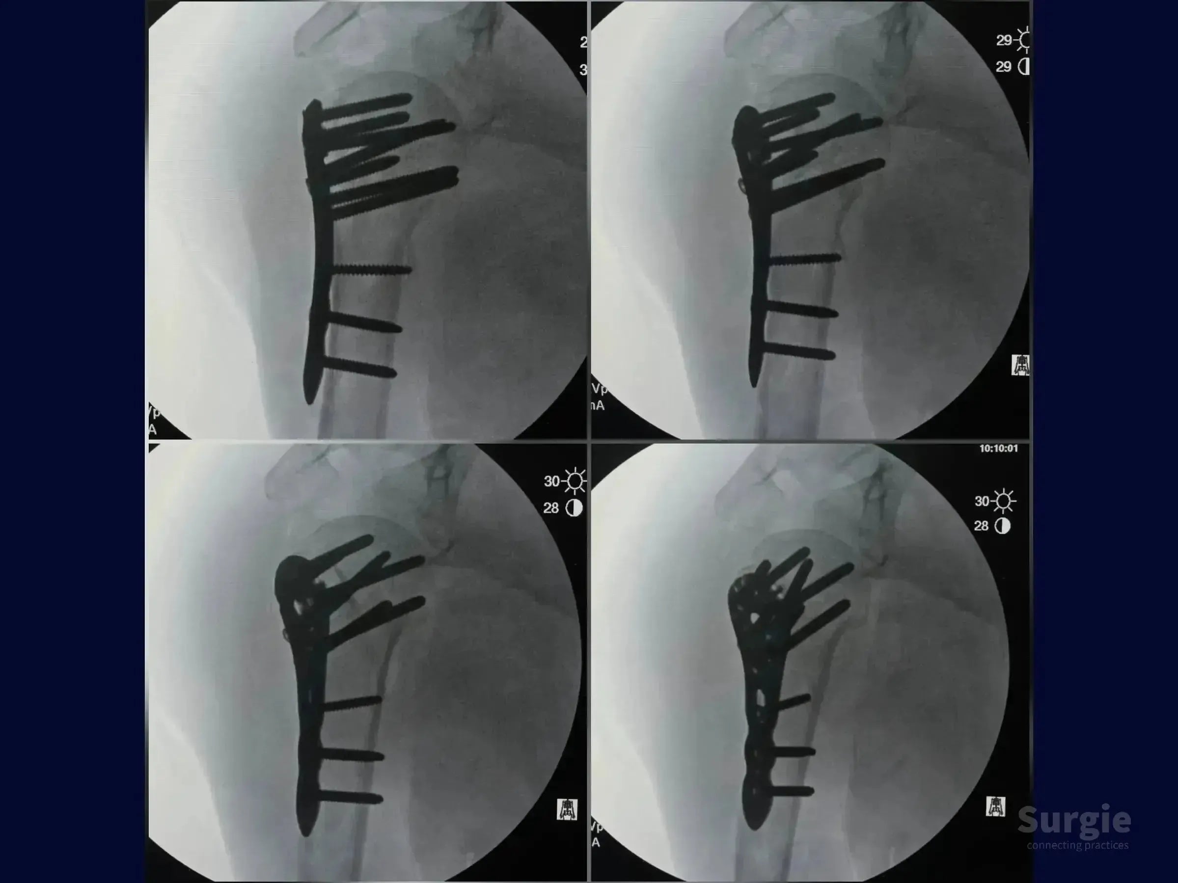 X-ray showing a proximal humerus four-part fracture fixed with a metal locking plate and screws.