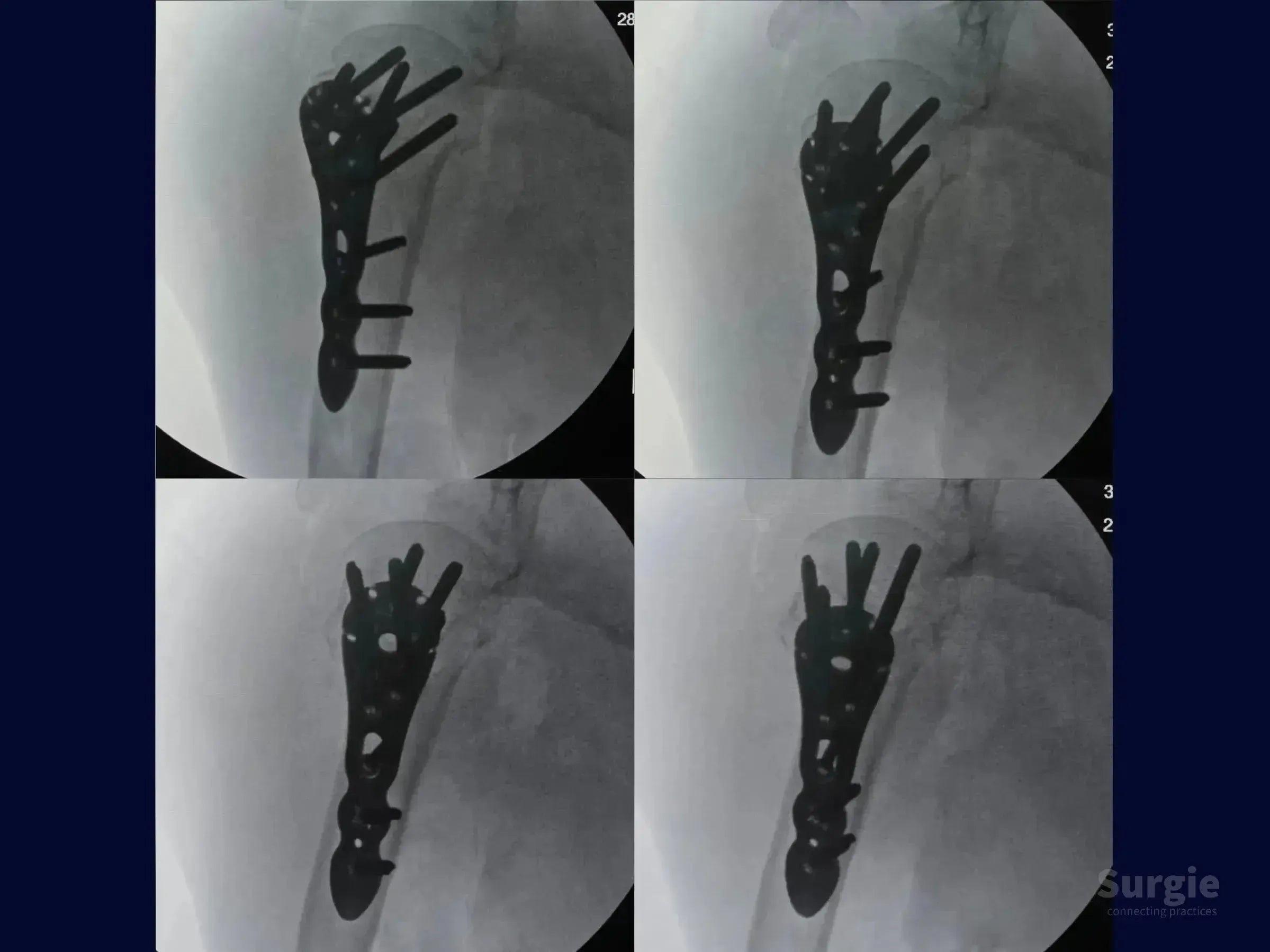X-ray showing a proximal humerus four-part fracture repaired with a locking plate and multiple fixation screws.