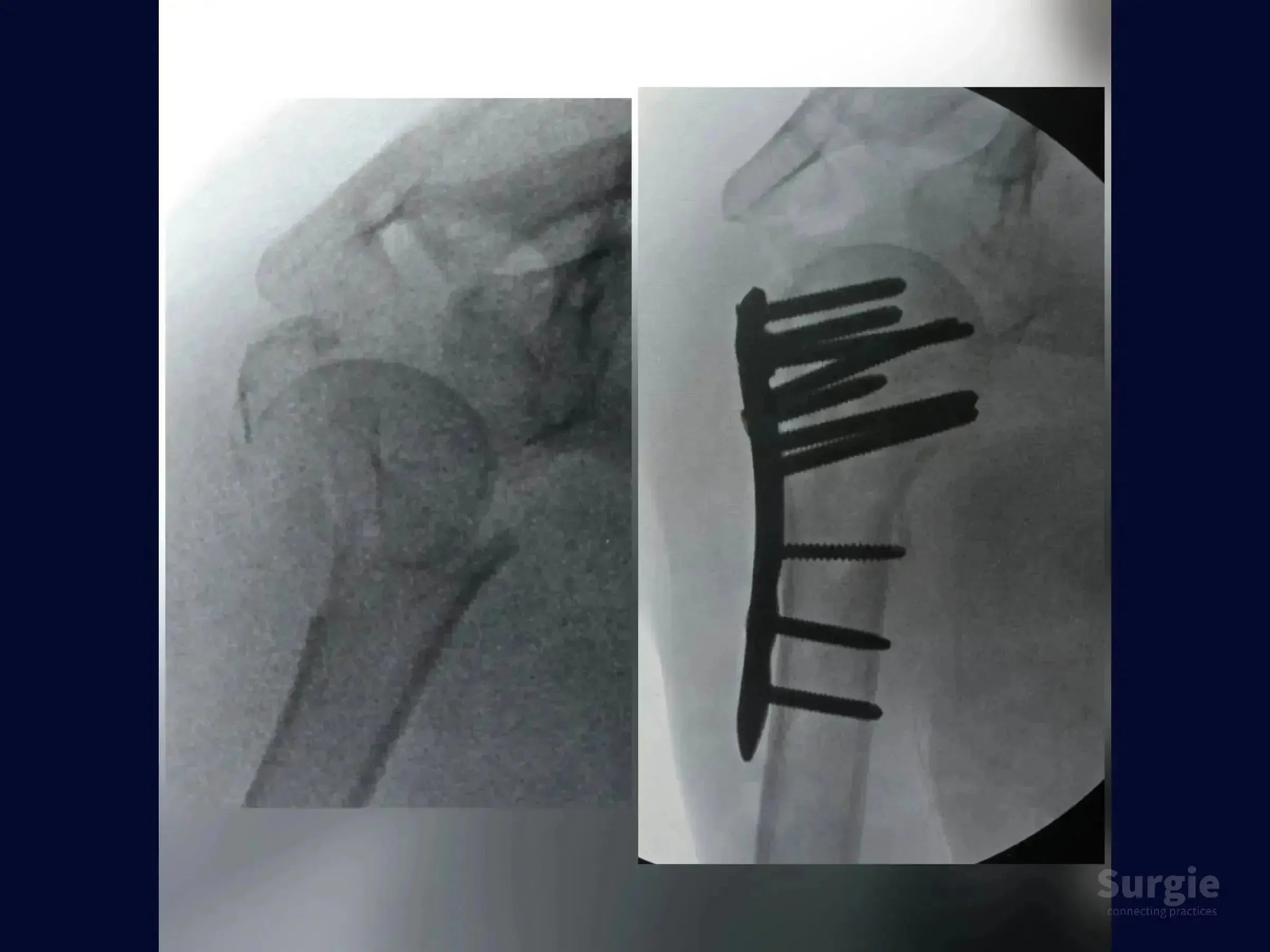 X-ray showing a four-part proximal humerus fracture before and after surgical fixation with a metal locking plate and screws.