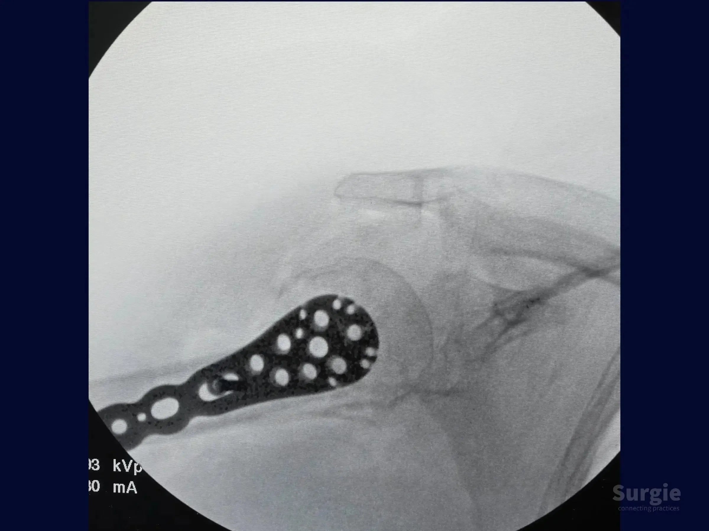 Fluoroscopic view of a proximal humerus locking plate fixed to a four-part fracture with calcar screw stabilization.