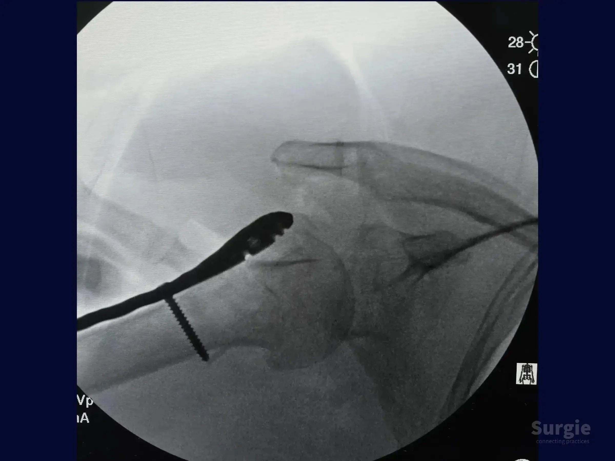 Fluoroscopic X-ray showing a proximal humerus fracture fixed with a locking plate and screws for anatomical reduction.