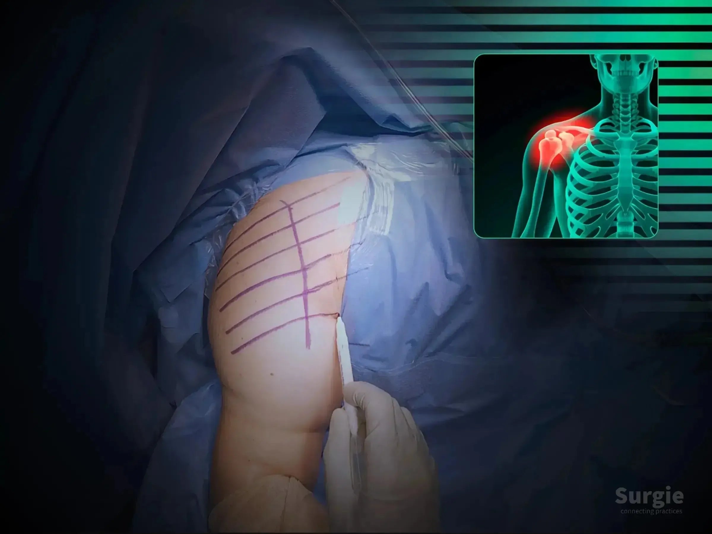 Surgeon marking a shoulder for deltopectoral incision with an anatomical X-ray overlay showing a proximal humerus fracture.