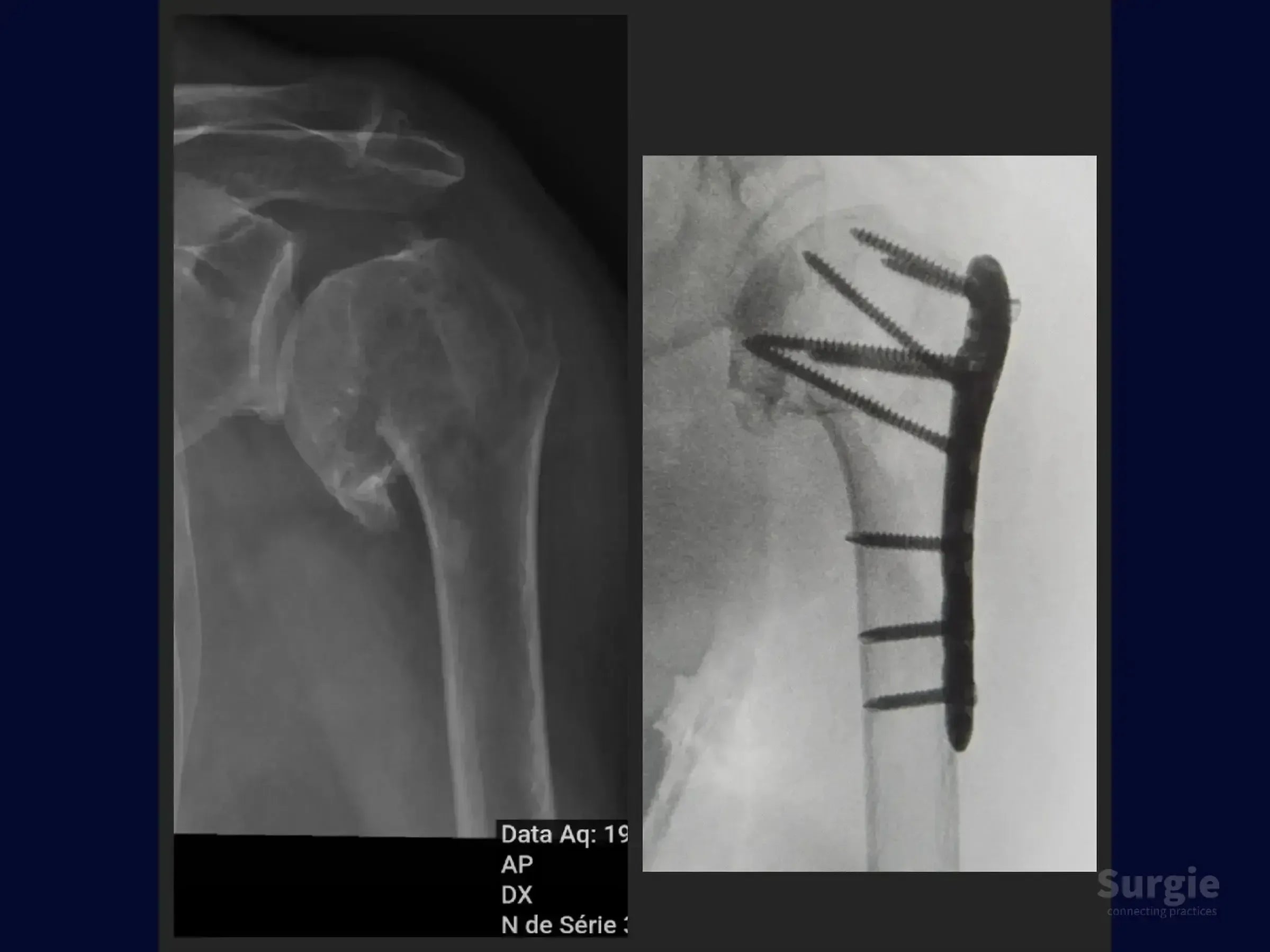 X-ray comparison of a proximal humerus fracture before and after surgical plate and screw fixation.