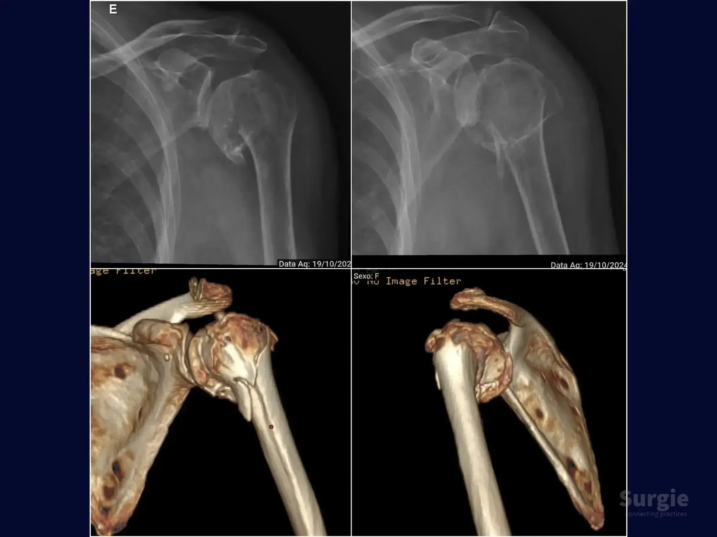 X-ray and 3D CT scan showing a complex proximal humerus fracture with bone displacement and glenohumeral joint involvement.