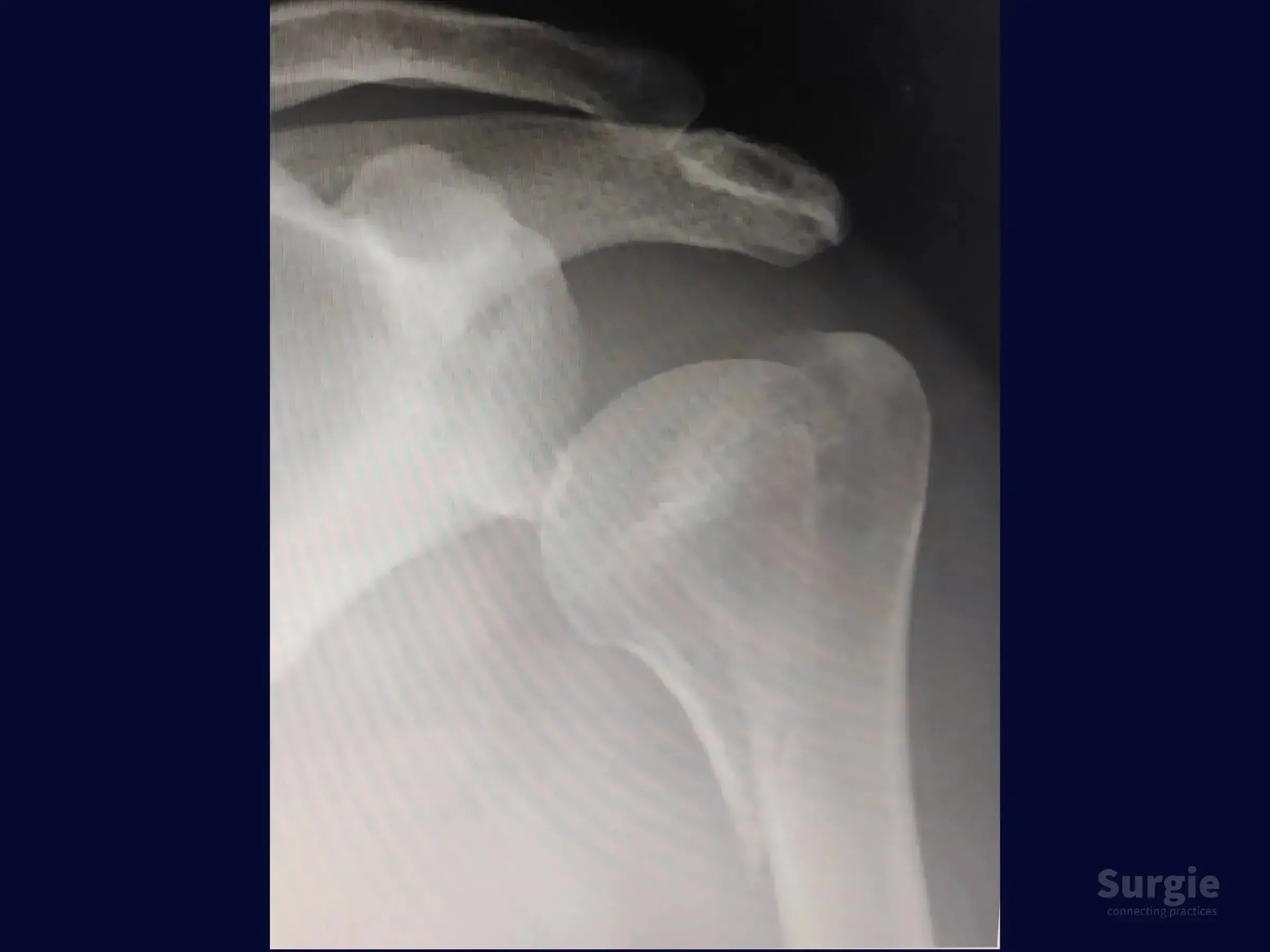X-ray showing a proximal humerus fracture with medial shear displacement before surgical plate stabilization.