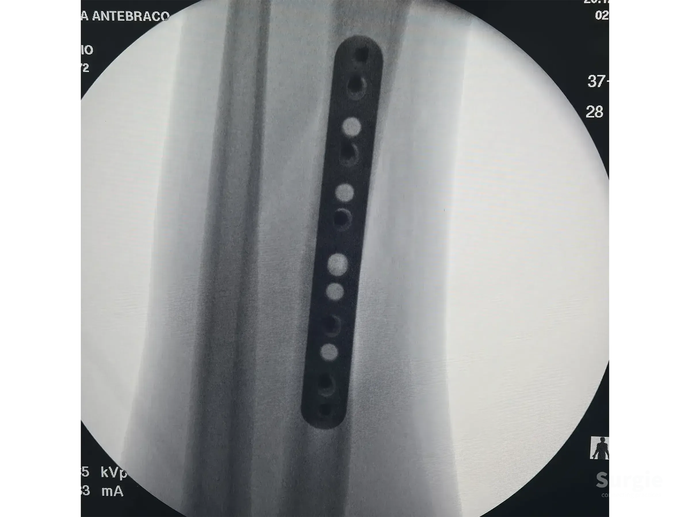 X-ray showing a 3.5 mm DCP plate fixed to a radial shaft fracture using the Thompson approach.