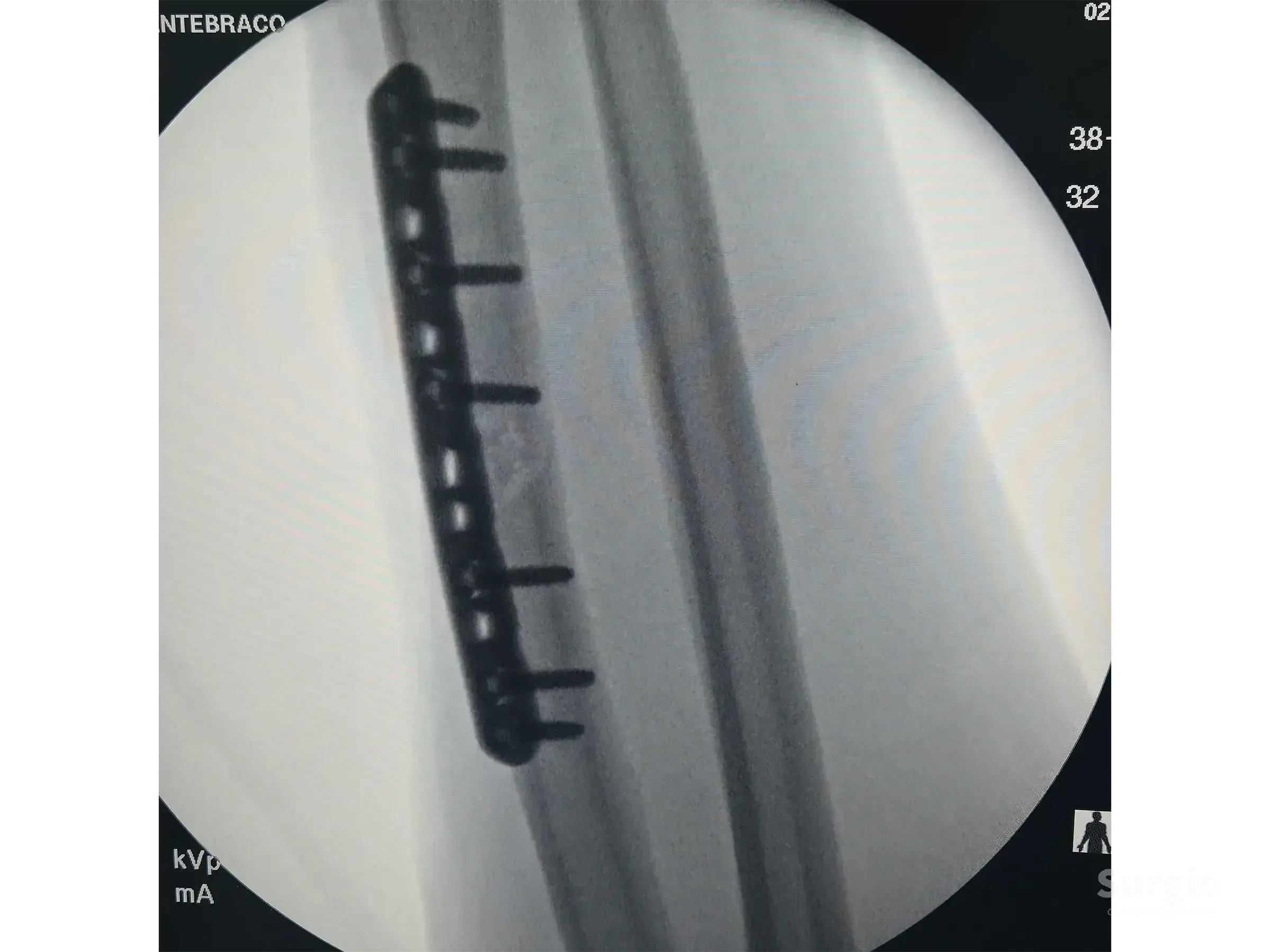 Fluoroscopic view of a radial shaft fracture fixed with a 3.5 mm DCP metal plate and screws for anatomic reduction.
