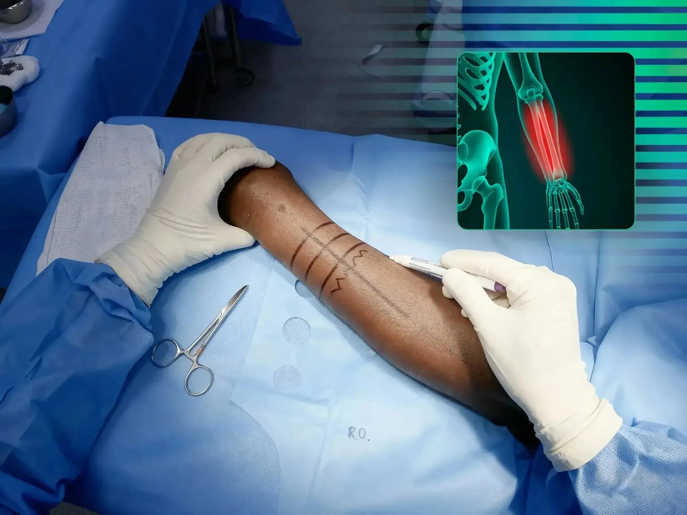 Surgeon marking a radial shaft incision site on an arm with an anatomical X-ray overlay for surgical planning.