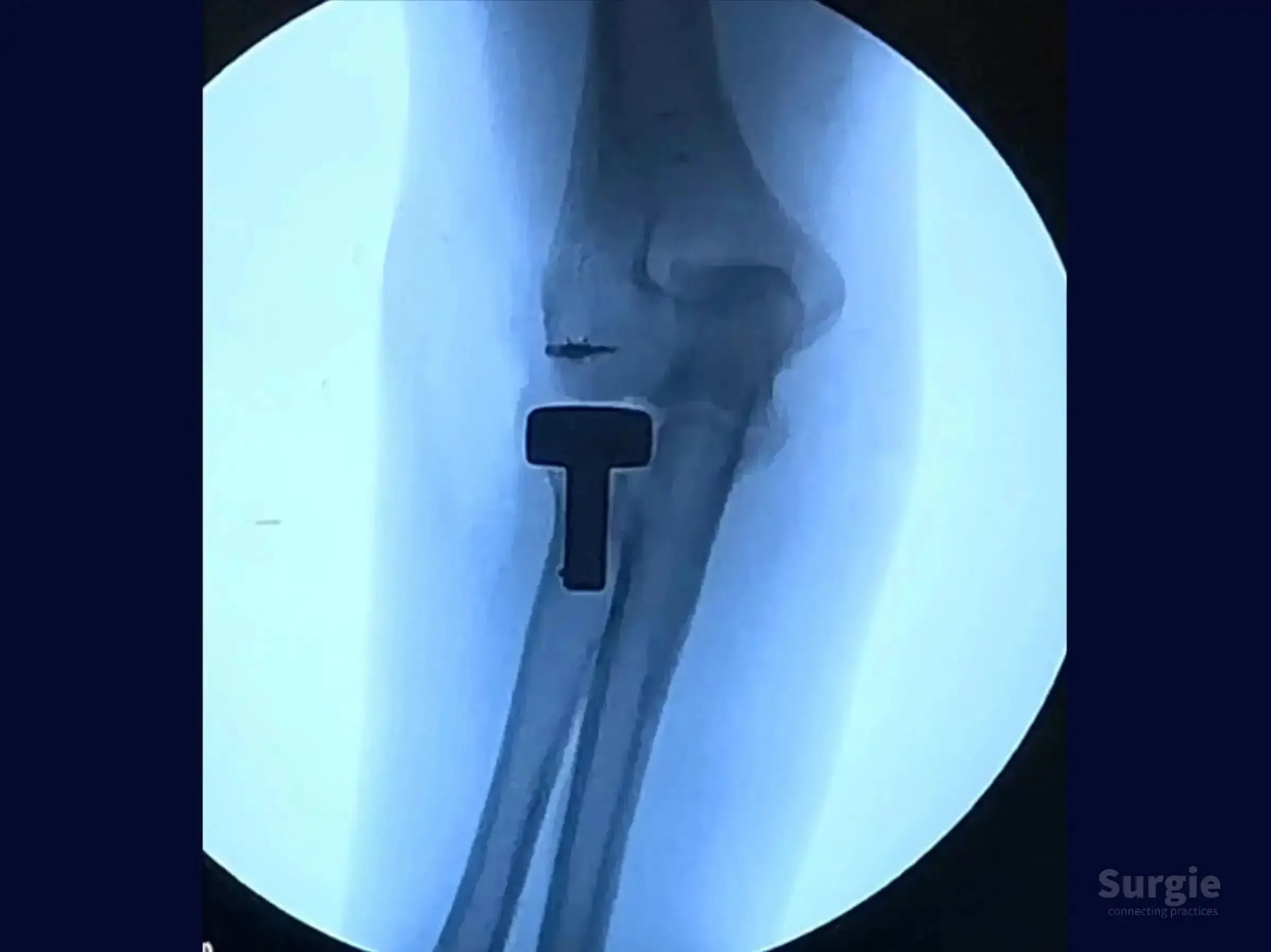 X-ray showing a metallic radial head prosthesis implanted in the elbow joint to treat a multifragmentary fracture.