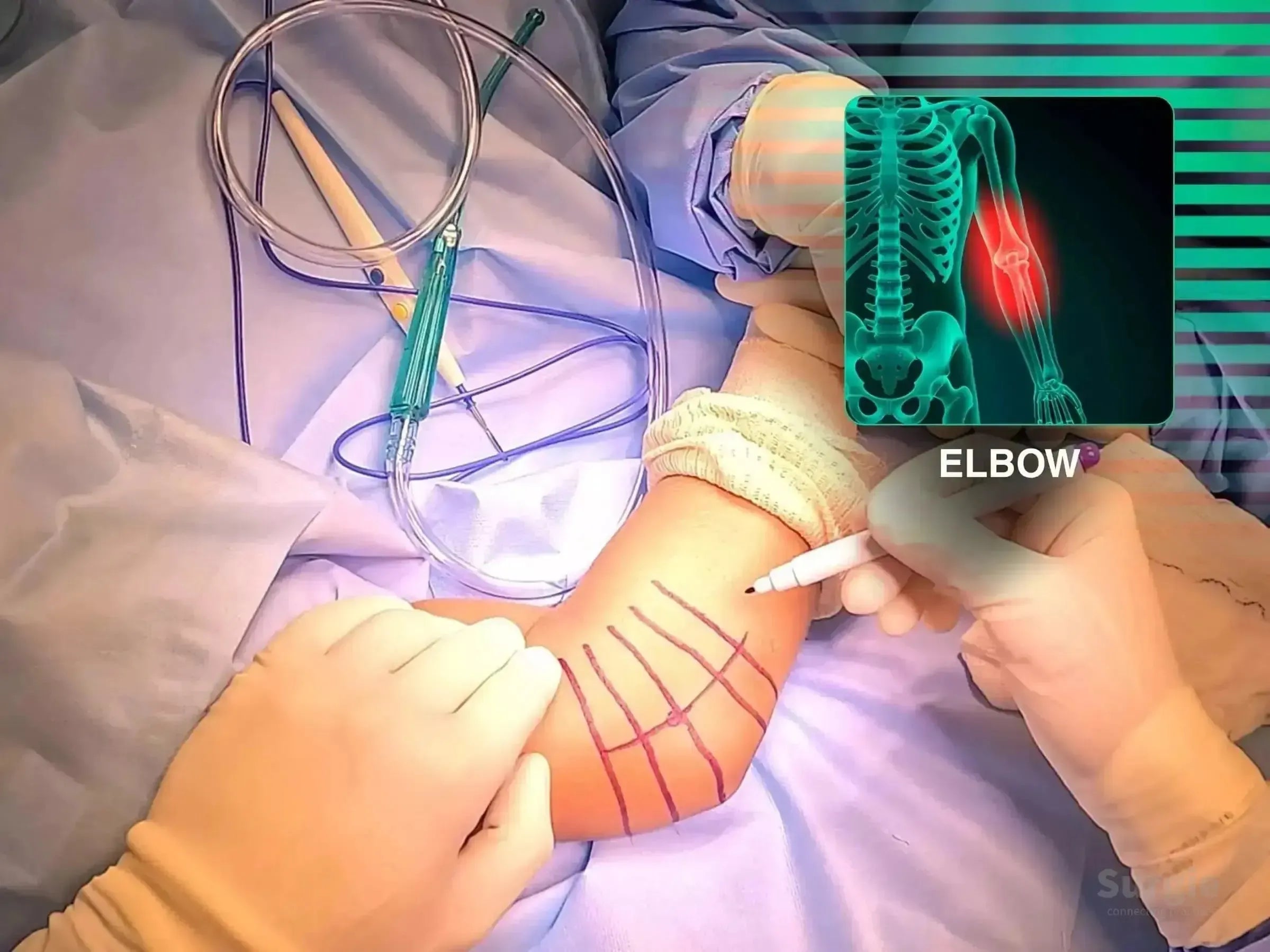 Surgeon marking a patient's elbow for radial head arthroplasty with an anatomical X-ray overlay highlighting the joint.