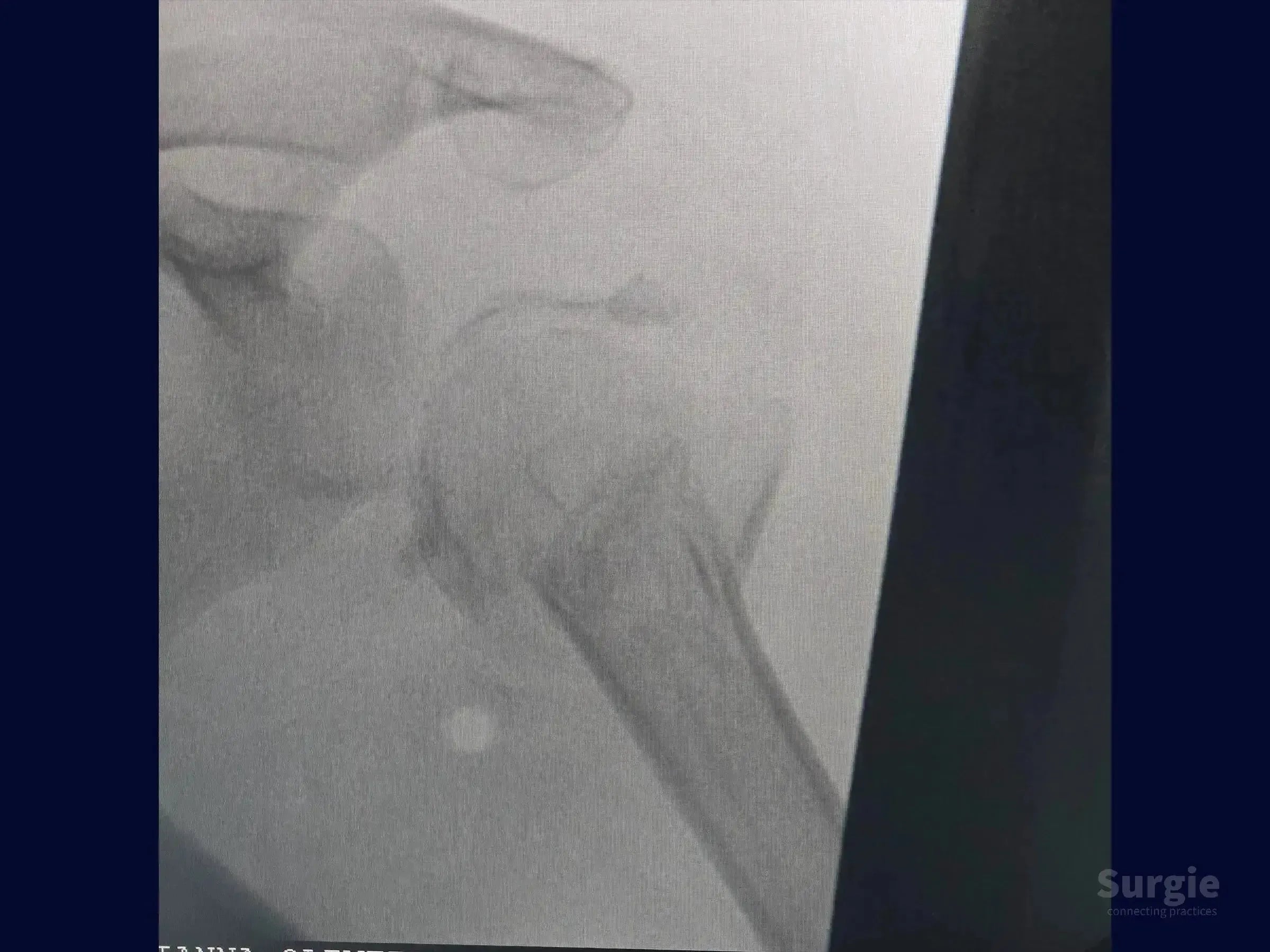 X-ray showing a complex four-part proximal humerus fracture with displaced bone fragments in the shoulder joint.