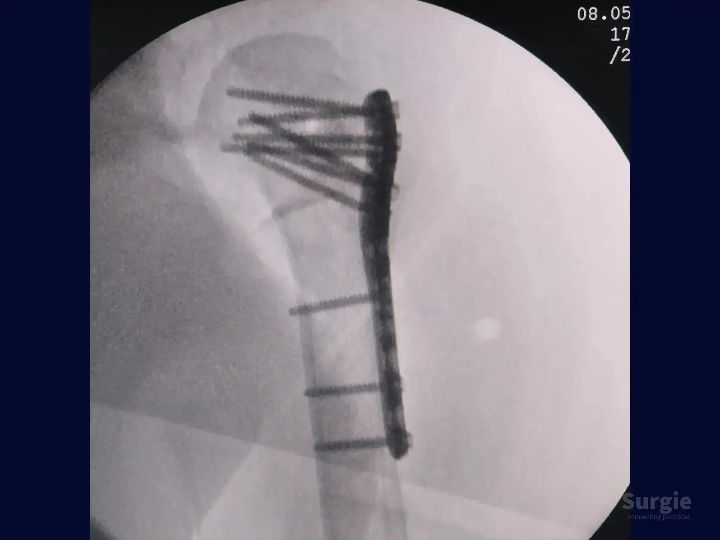 X-ray showing a proximal humerus fracture fixed with a metallic locking plate and multiple screws.