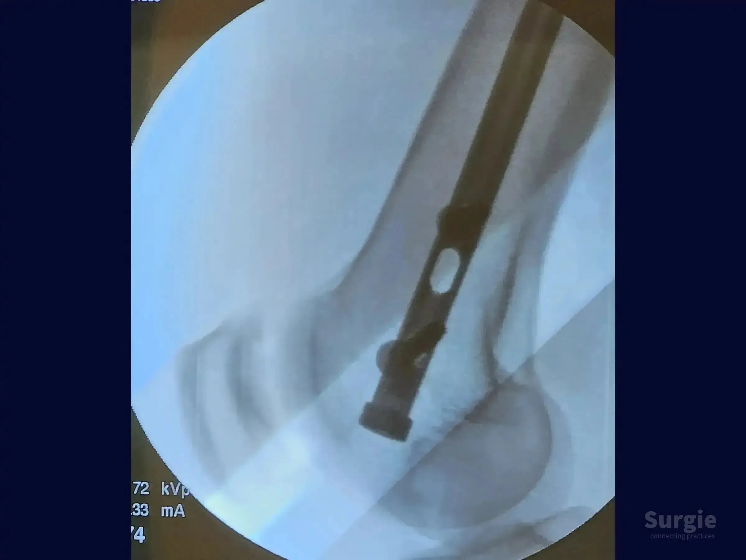 Fluoroscopic X-ray showing a metal intramedullary nail inserted into a human femur for fracture fixation.