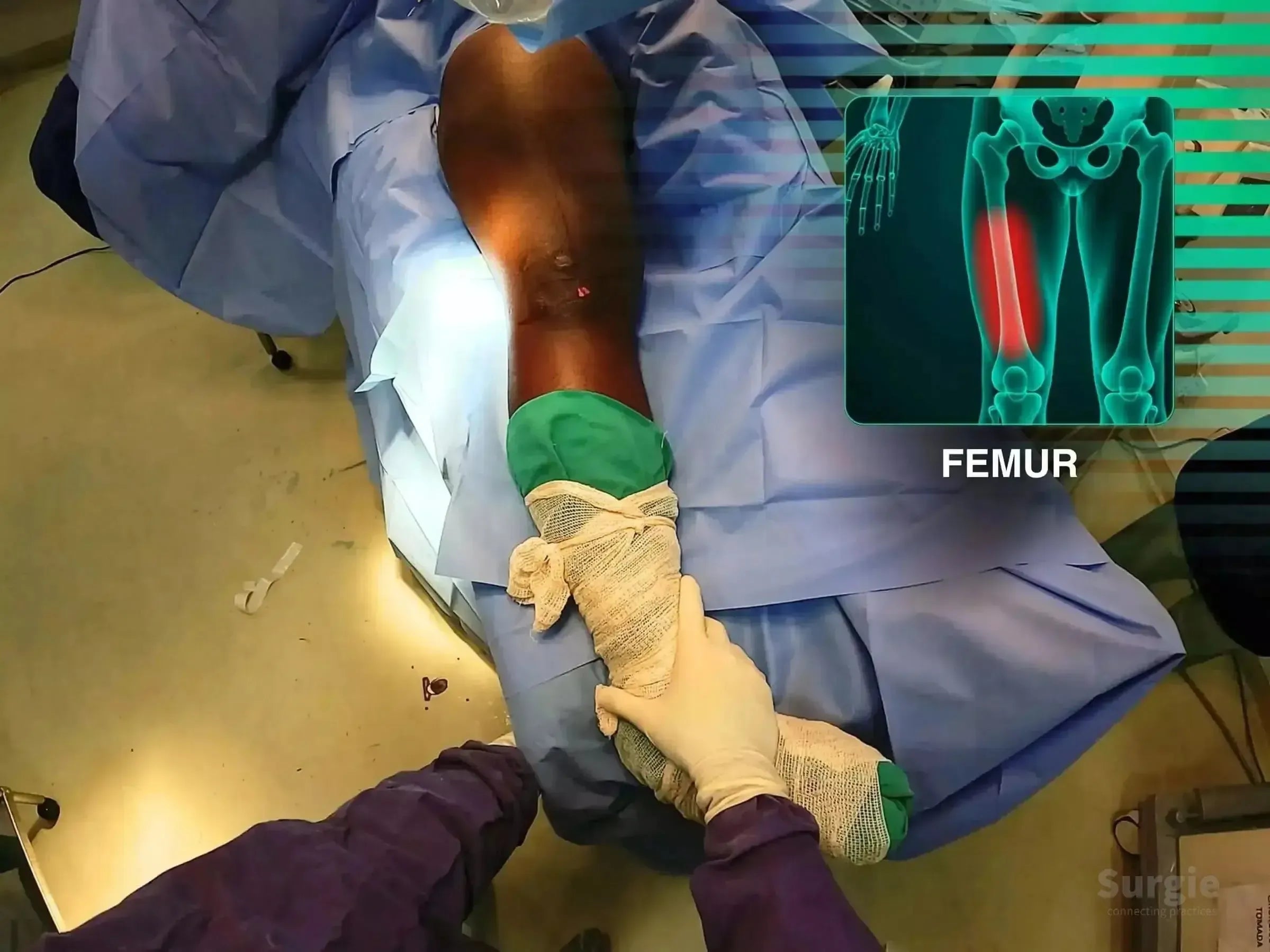 Surgeon performing femoral shaft fracture reduction with an anatomical overlay highlighting the femur on a blue surgical drape.
