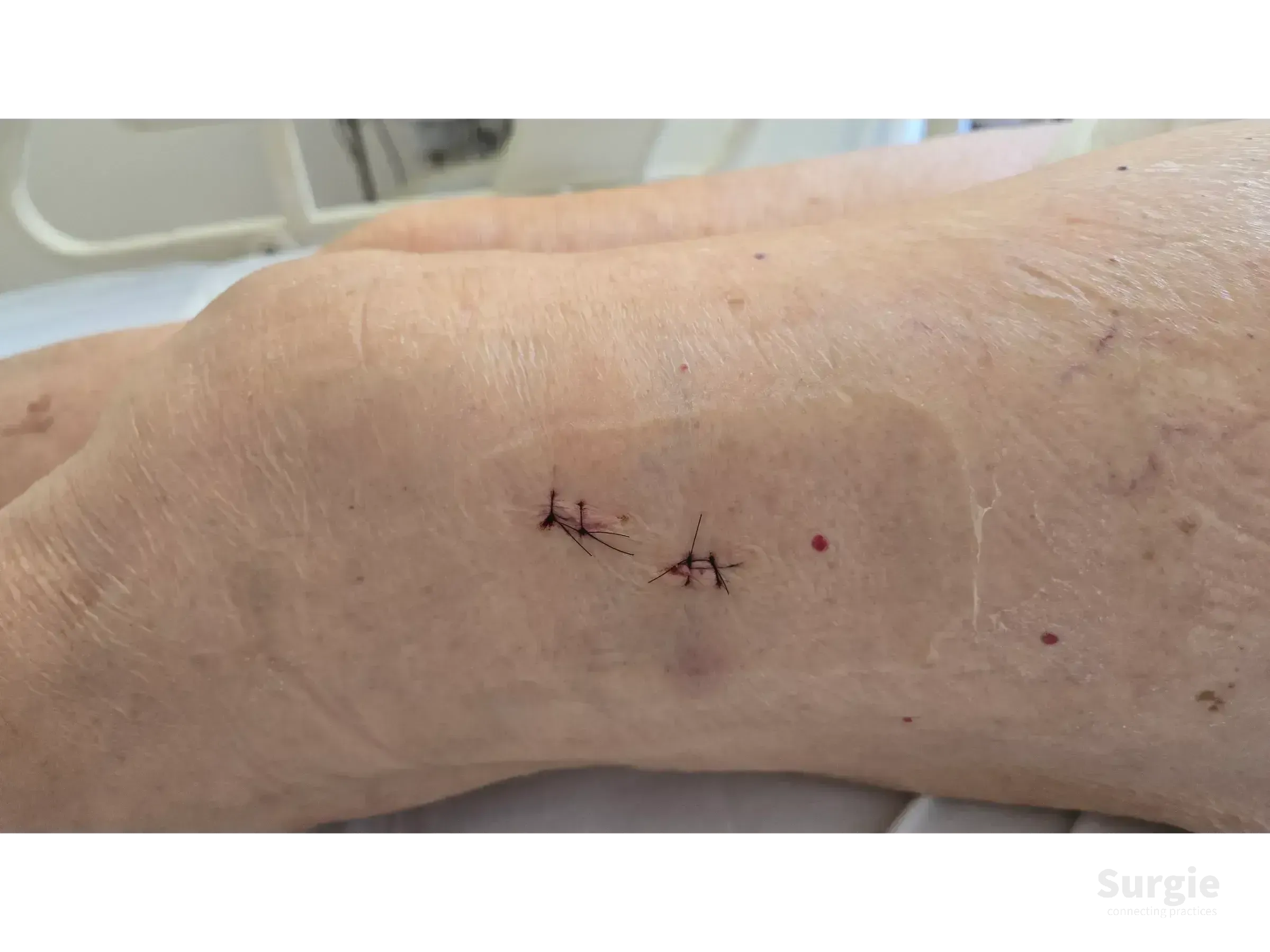 Two small surgical incisions on a patient's thigh closed with black sutures after minimally invasive fracture surgery.