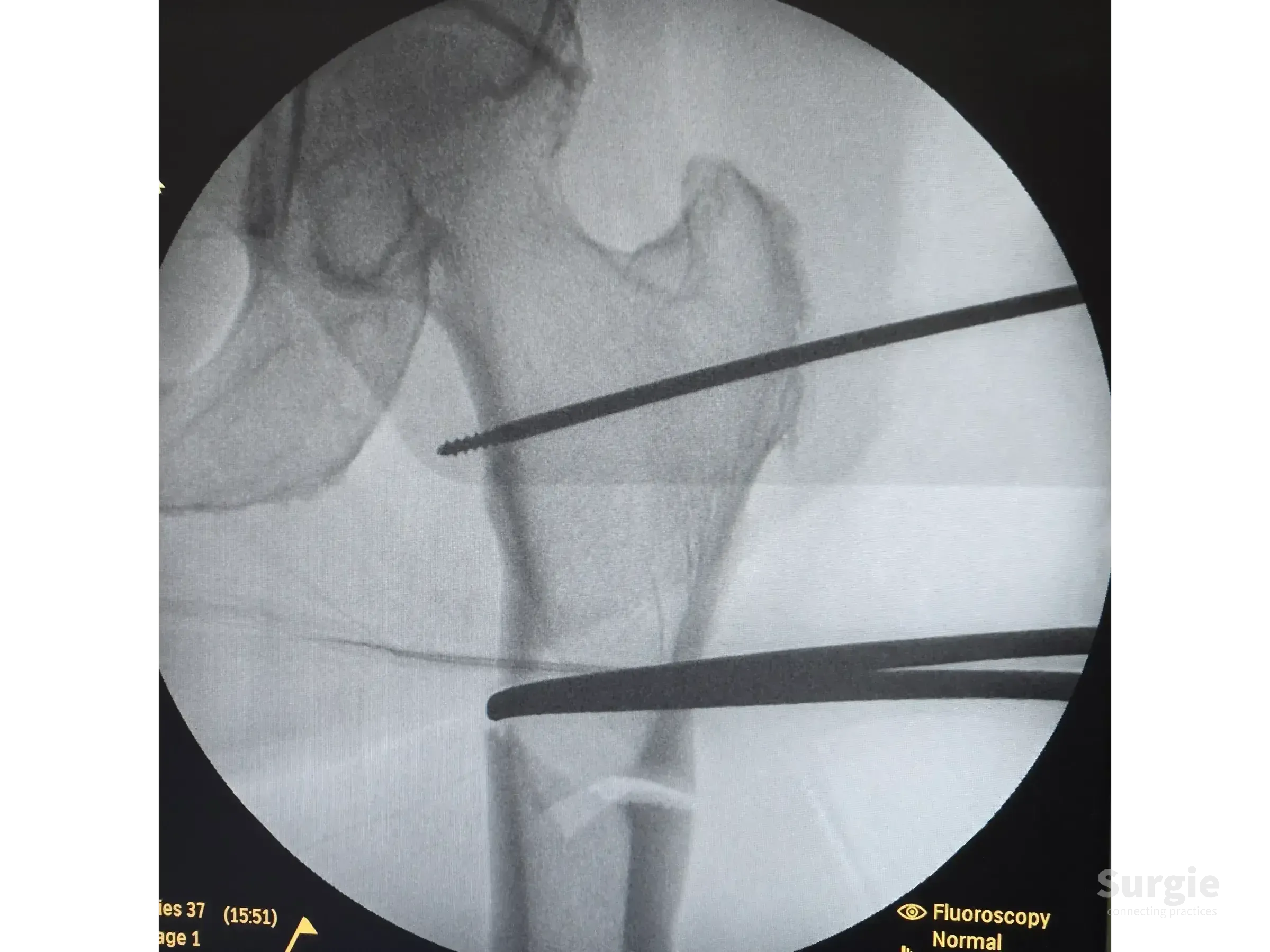 Fluoroscopic view of a subtrochanteric fracture being reduced with percutaneous surgical instruments and a guidewire.
