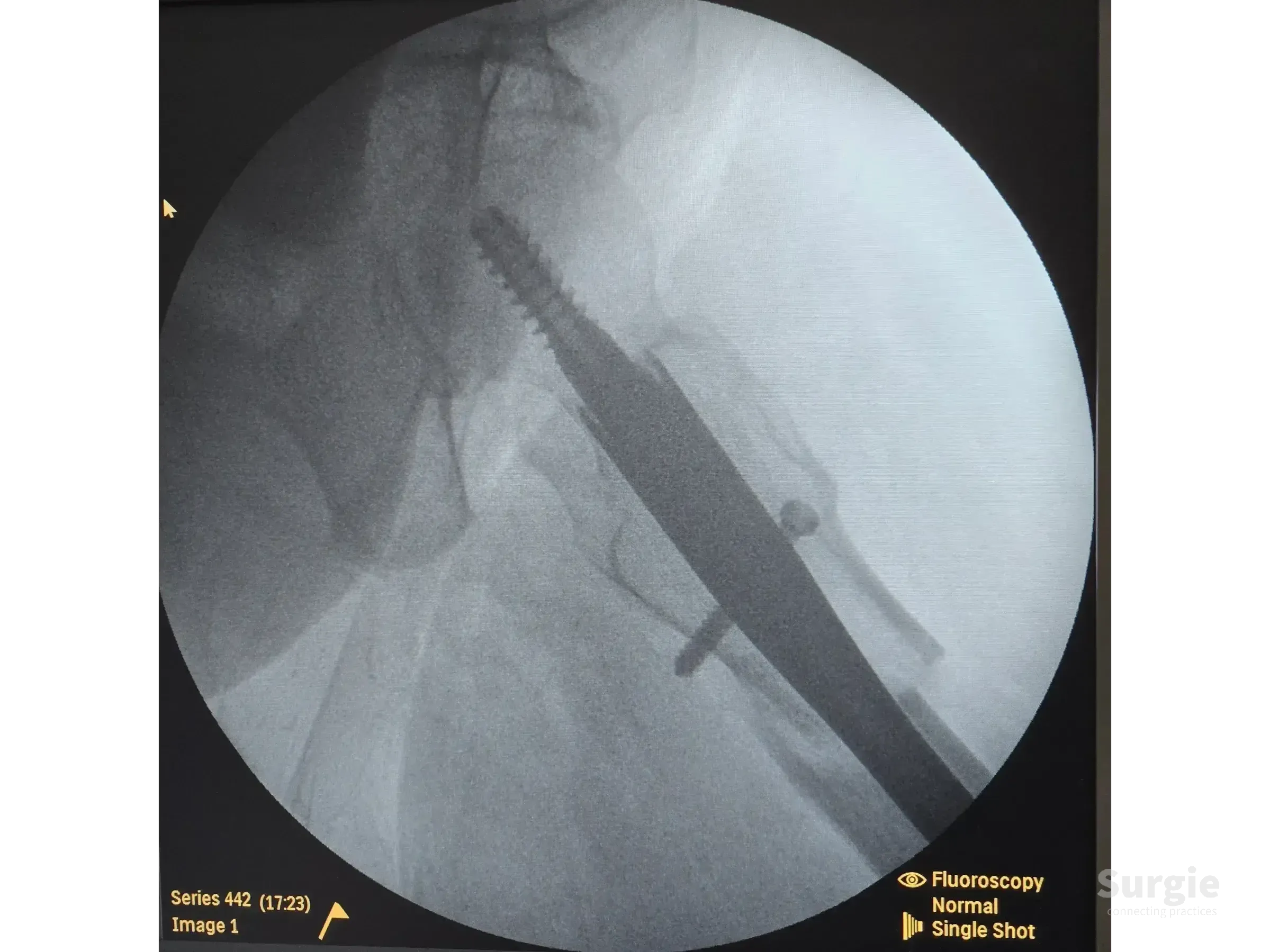 Fluoroscopic X-ray showing an intramedullary nail fixating a subtrochanteric femur fracture with a proximal locking screw.