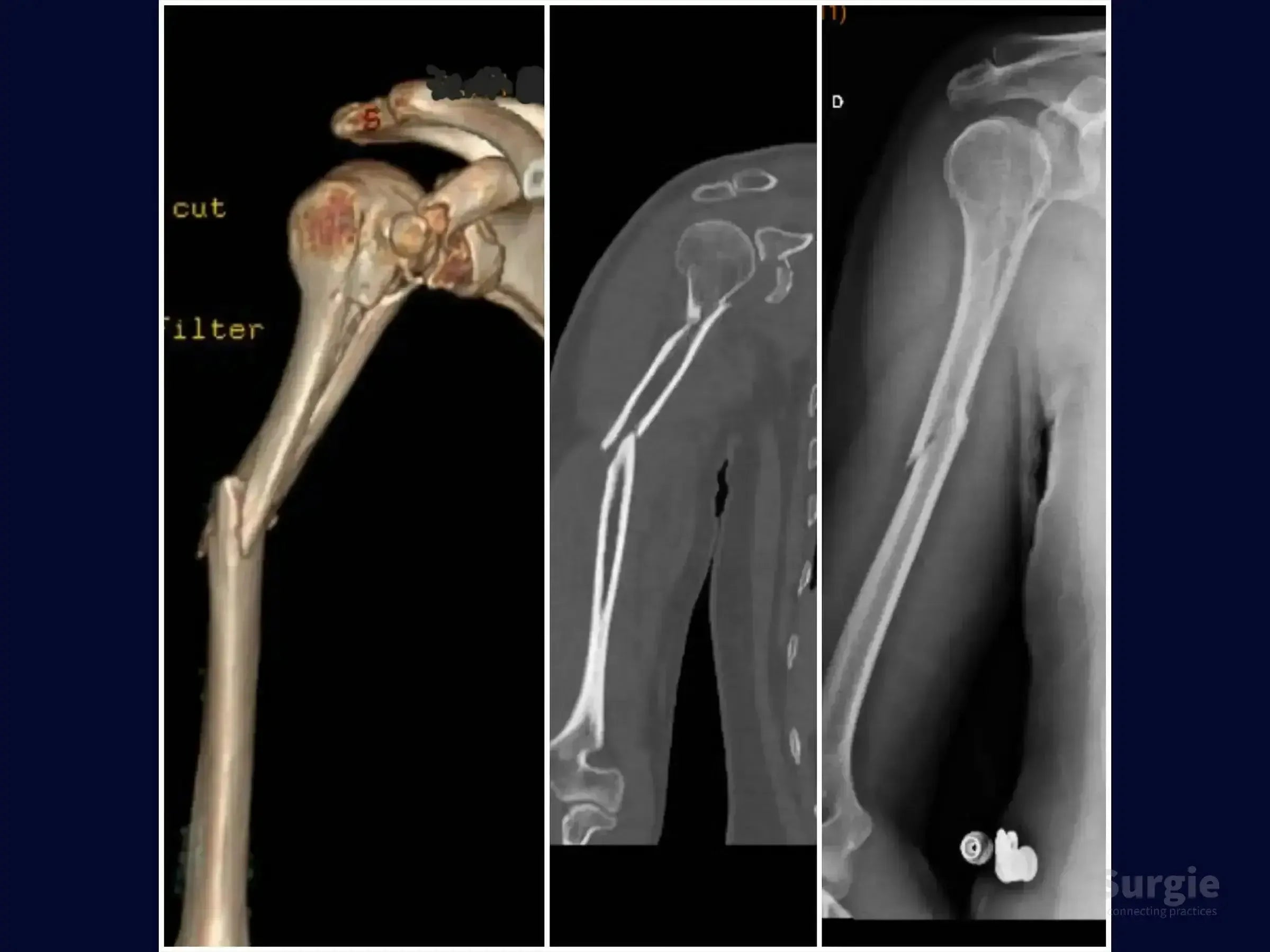 3D CT reconstruction and X-ray showing a segmental humeral fracture with glenoid and coracoid process involvement.
