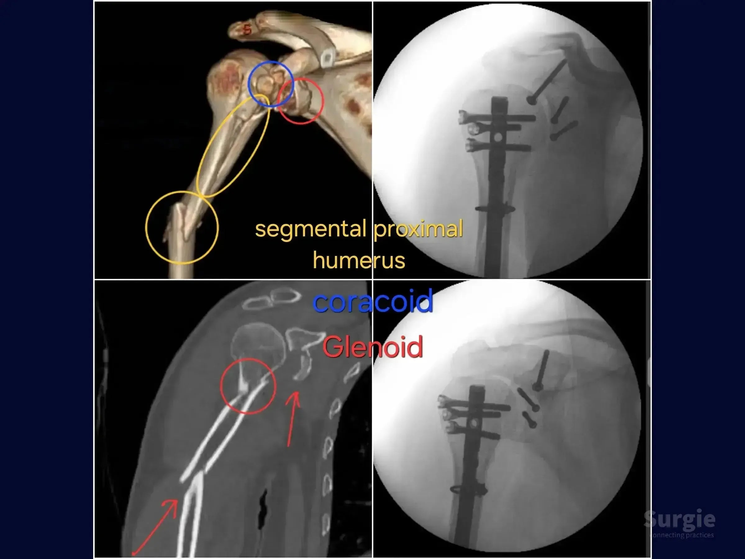 3D CT scan and X-ray showing segmental humeral fracture with glenoid and coracoid fixation using intramedullary nails.