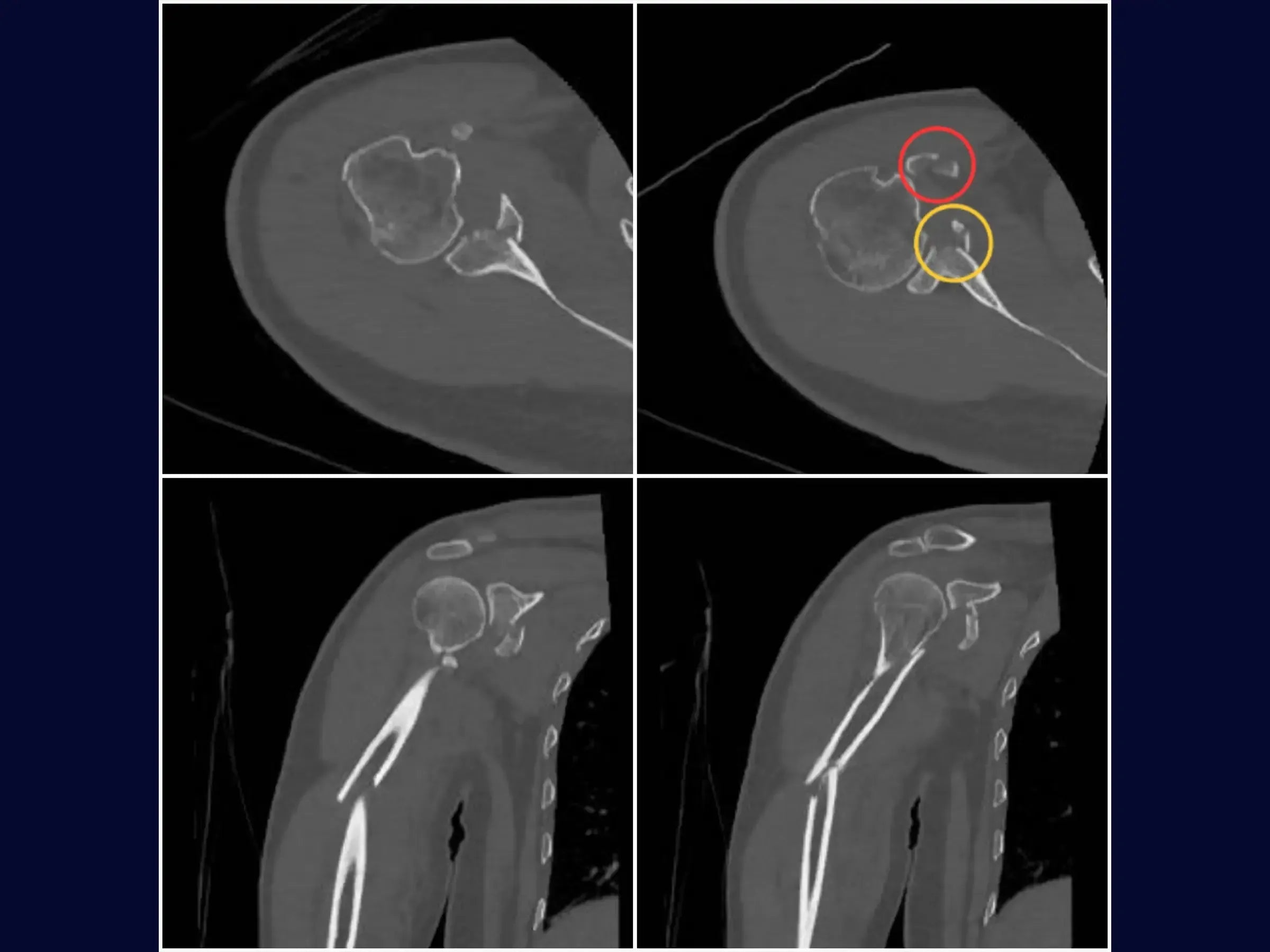 Segmentale Humerusfraktur assoziiert mit Glenoid- und Korakoidfrakturen