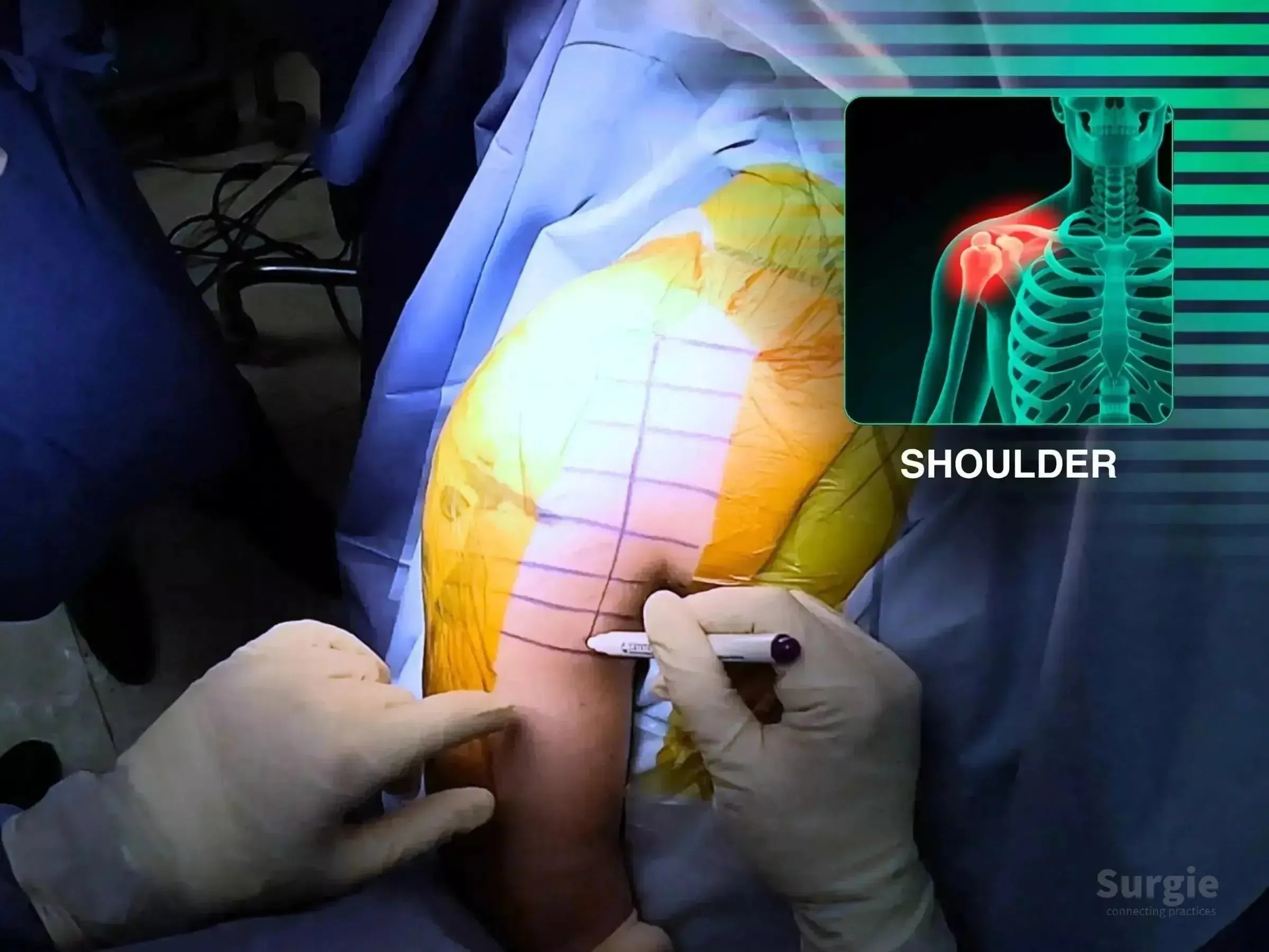 Surgeon marking a shoulder for a deltopectoral approach with a skeletal diagram overlay highlighting the injury site.
