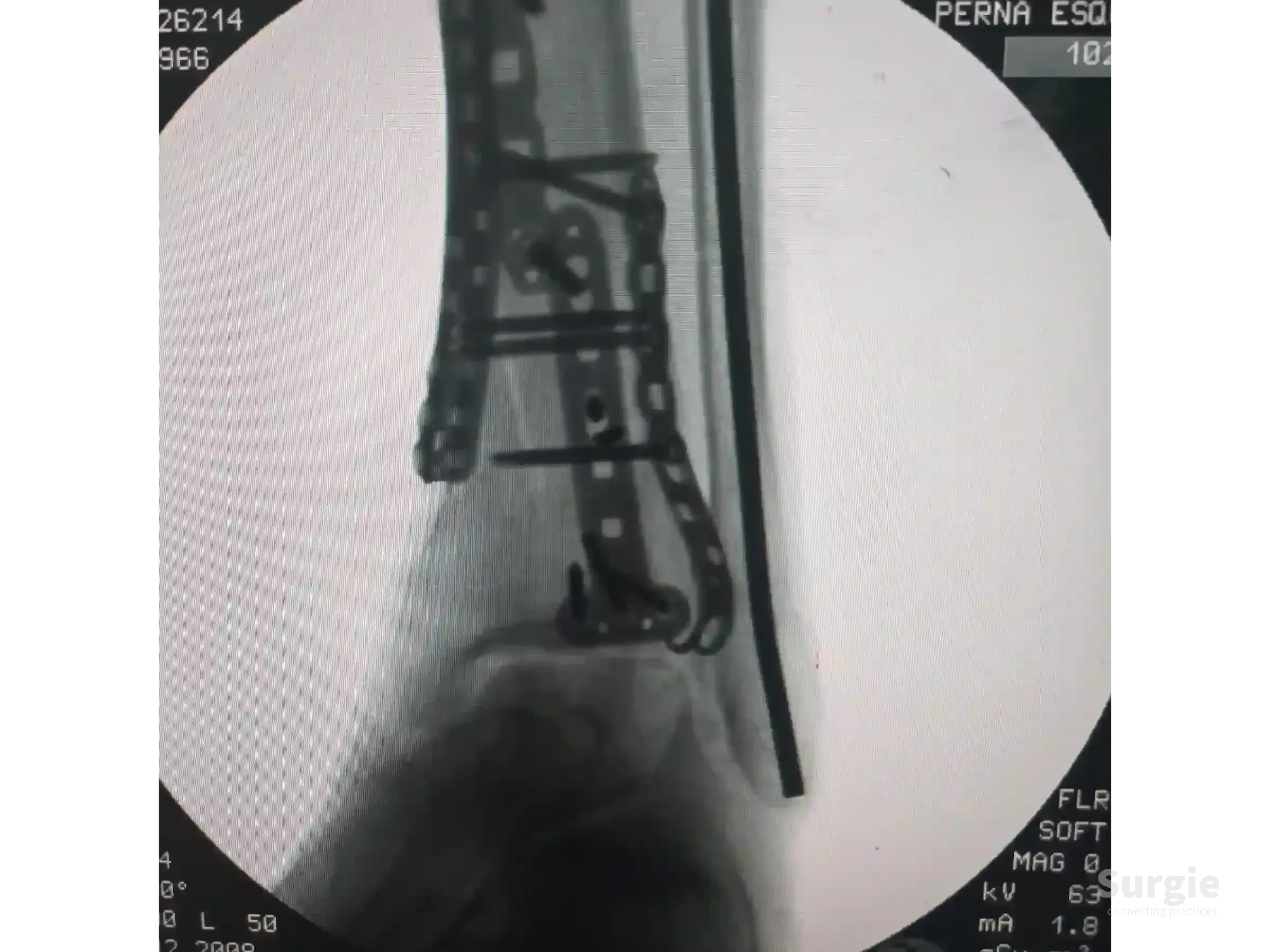 X-ray showing a tibial pilon fracture stabilized with a metal plate and screws along the distal tibia and ankle joint.