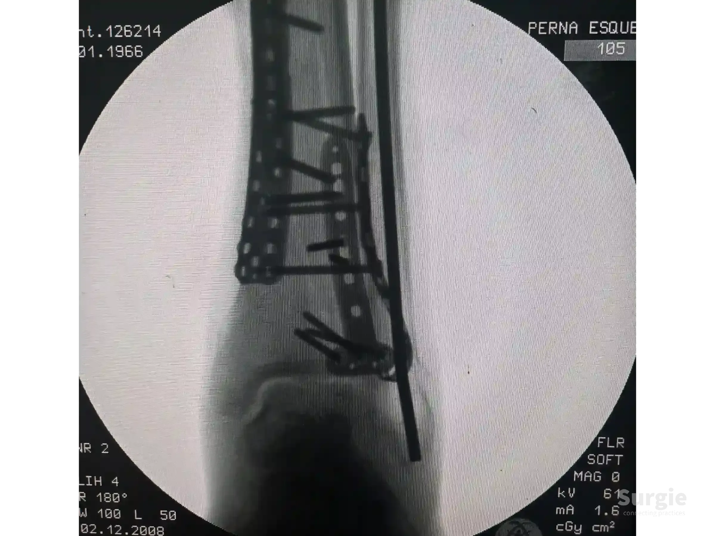 X-ray showing a tibial pilon fracture stabilized with metal plates and screws along the distal tibia and fibula.